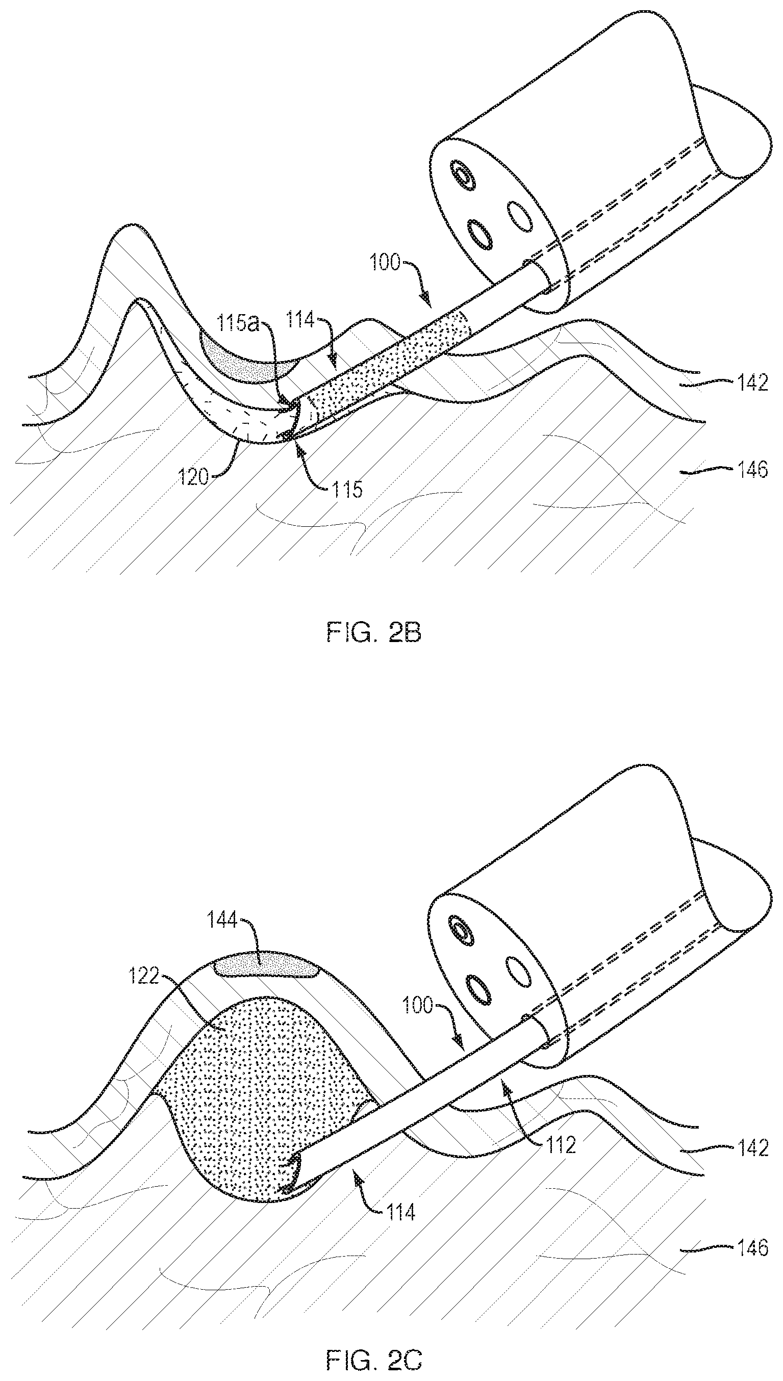 Patent US11793539 Figure 3 – Systems and methods for submucosal tissue separation
