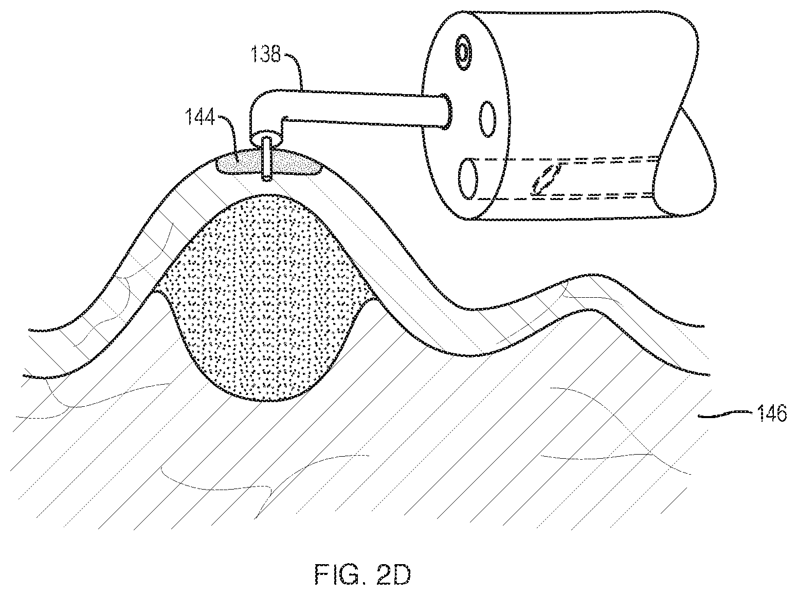 Patent US11793539 Figure 4 – Systems and methods for submucosal tissue separation