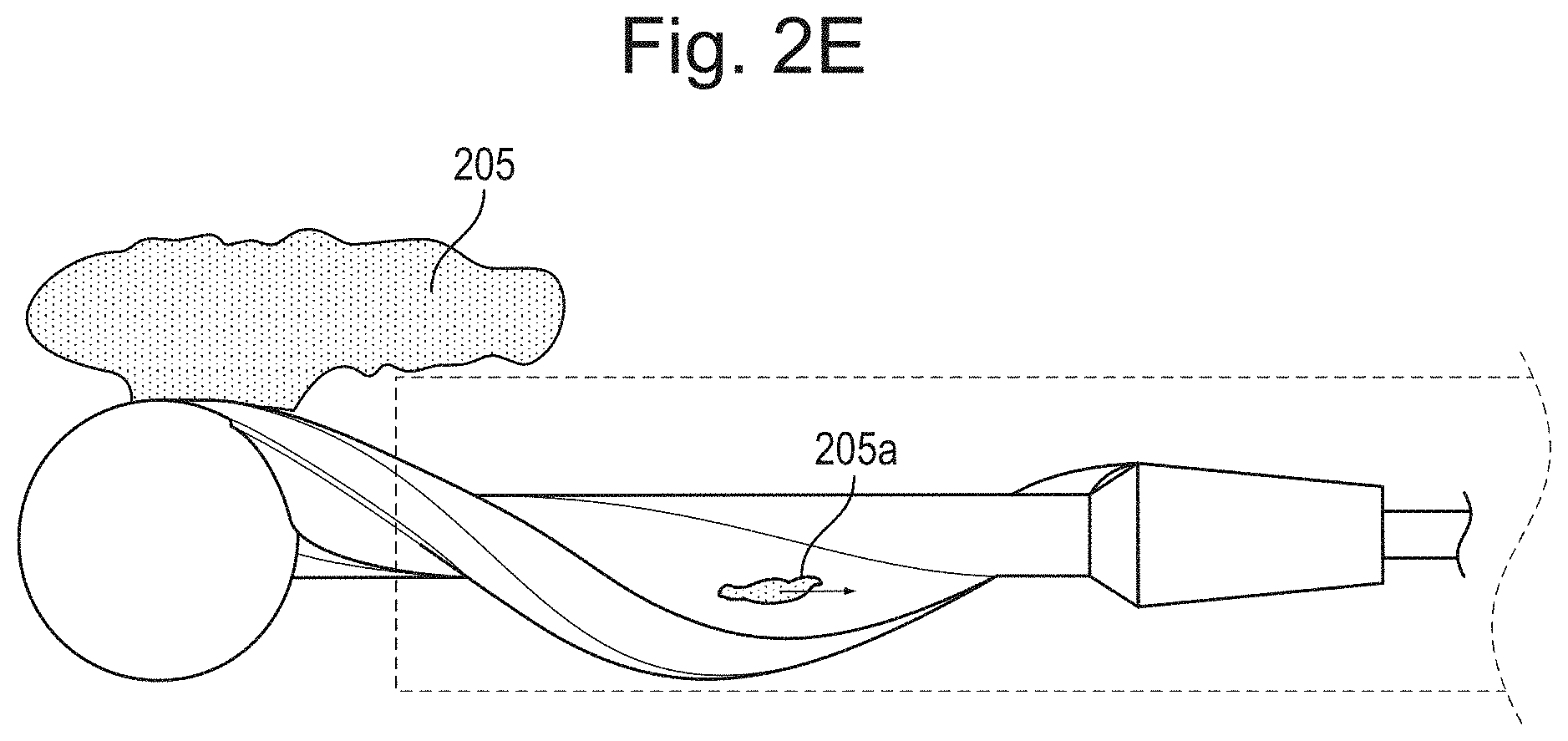 Patent US11793542 Figure 3 – Helical separator and methods of operating the same