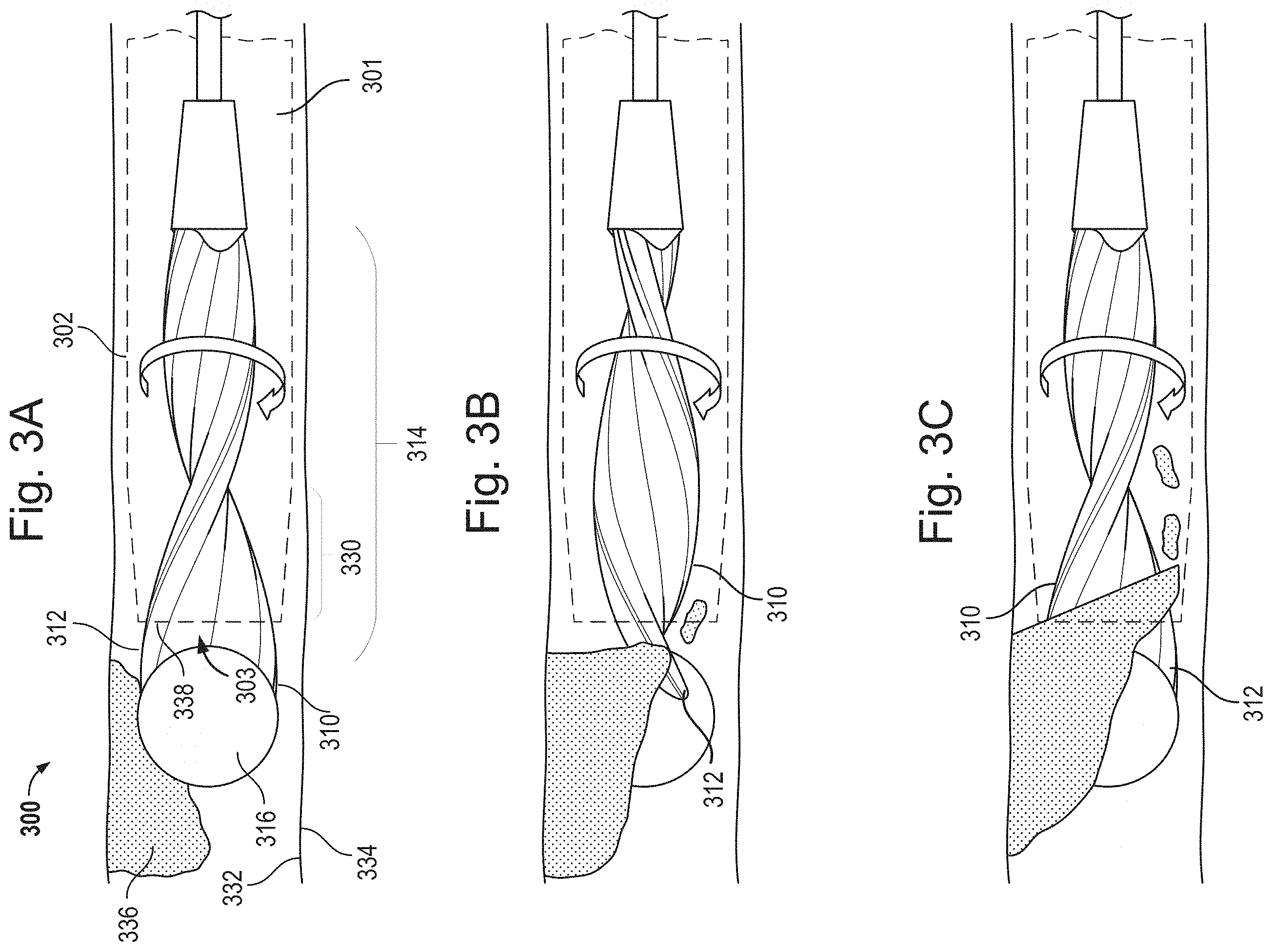 Patent US11793542 Figure 4 – Helical separator and methods of operating the same