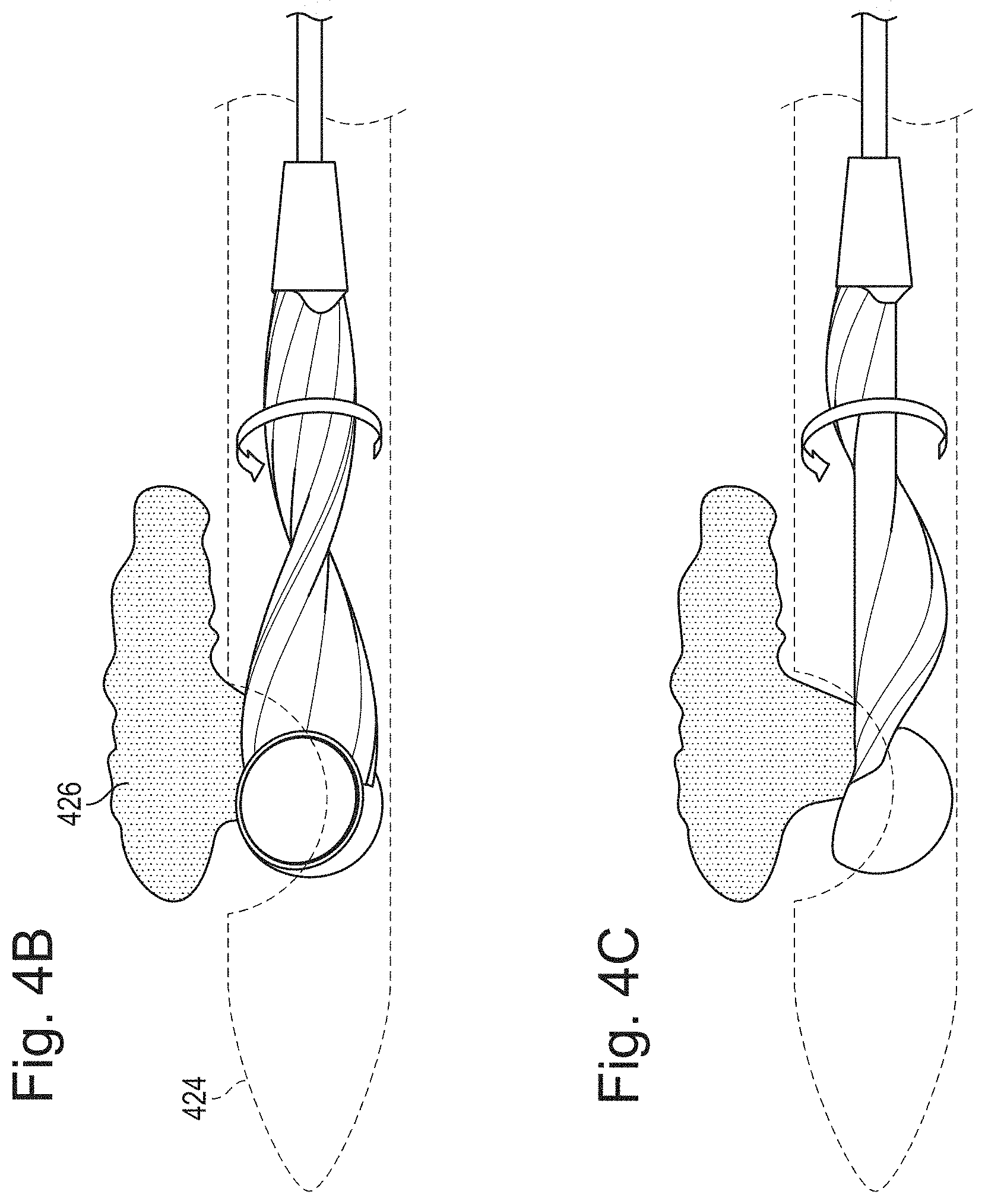 Patent US11793542 Figure 6 – Helical separator and methods of operating the same