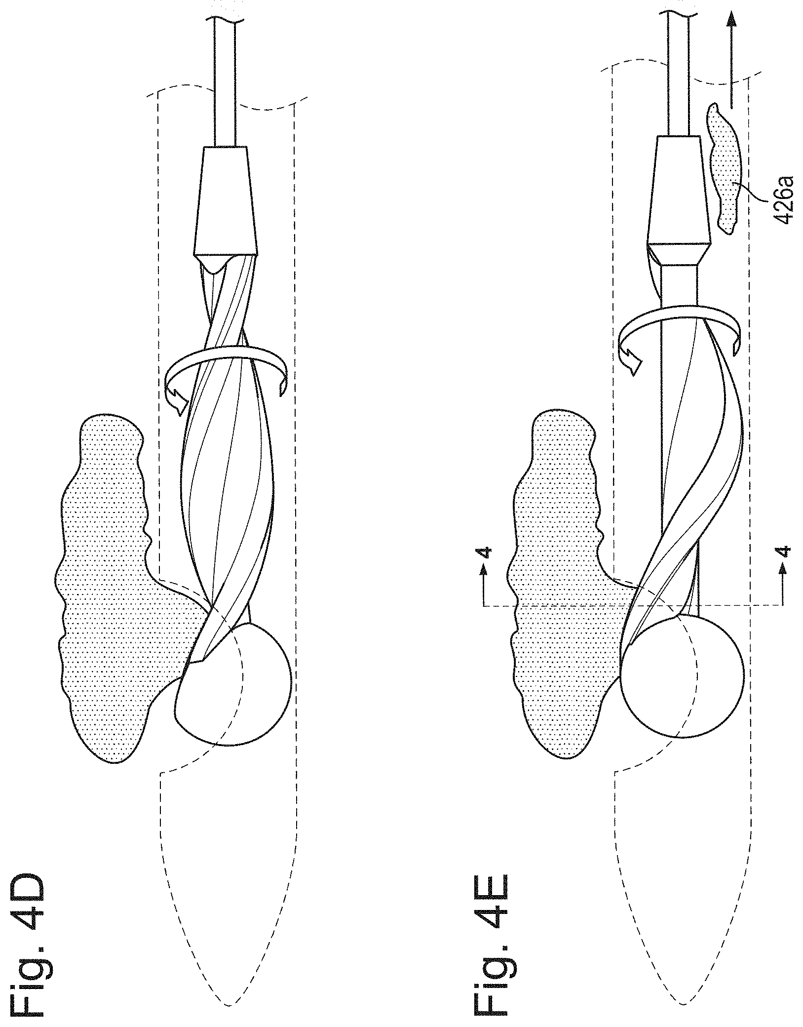 Patent US11793542 Figure 7 – Helical separator and methods of operating the same
