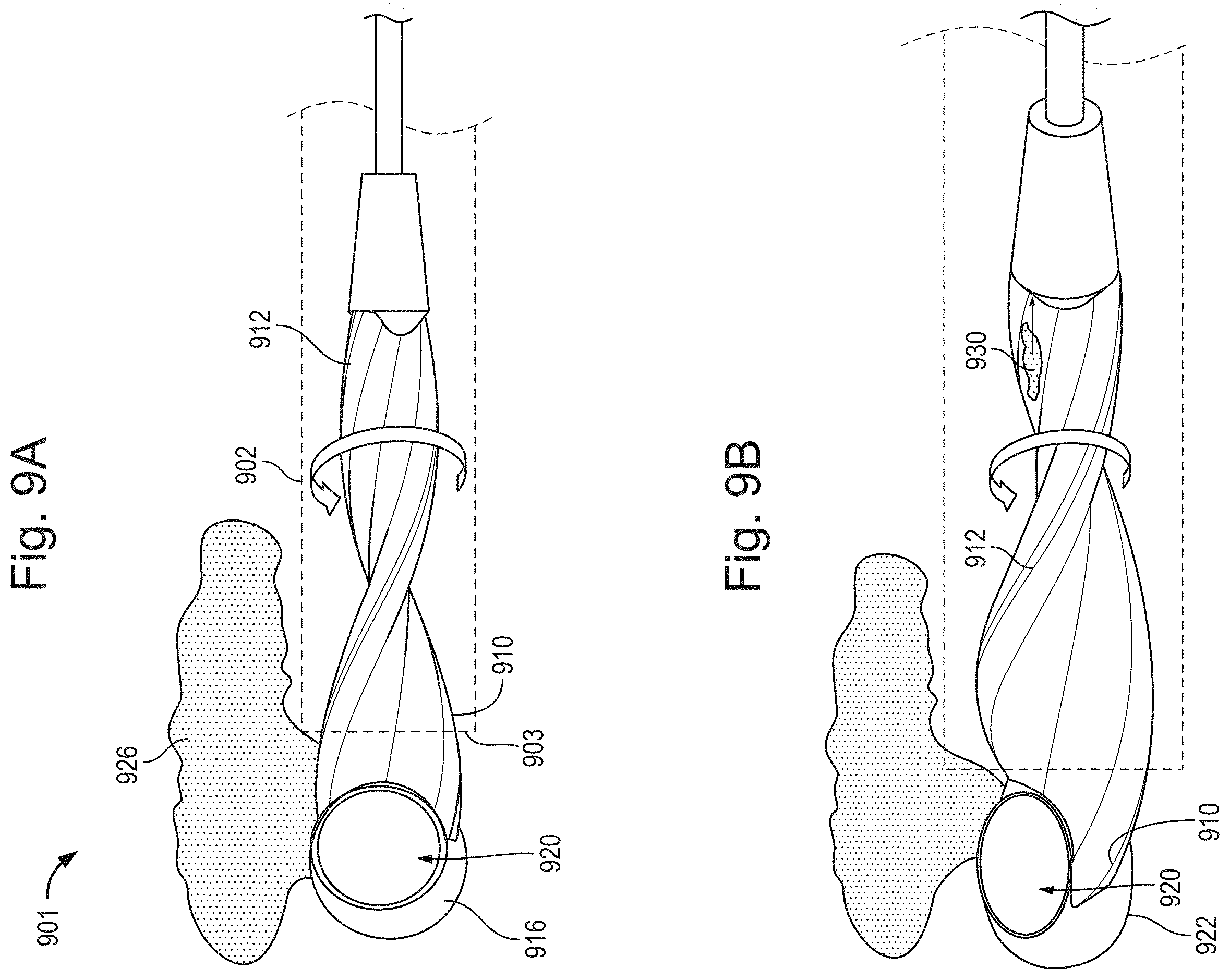 Patent US11793542 Figure 11 – Helical separator and methods of operating the same