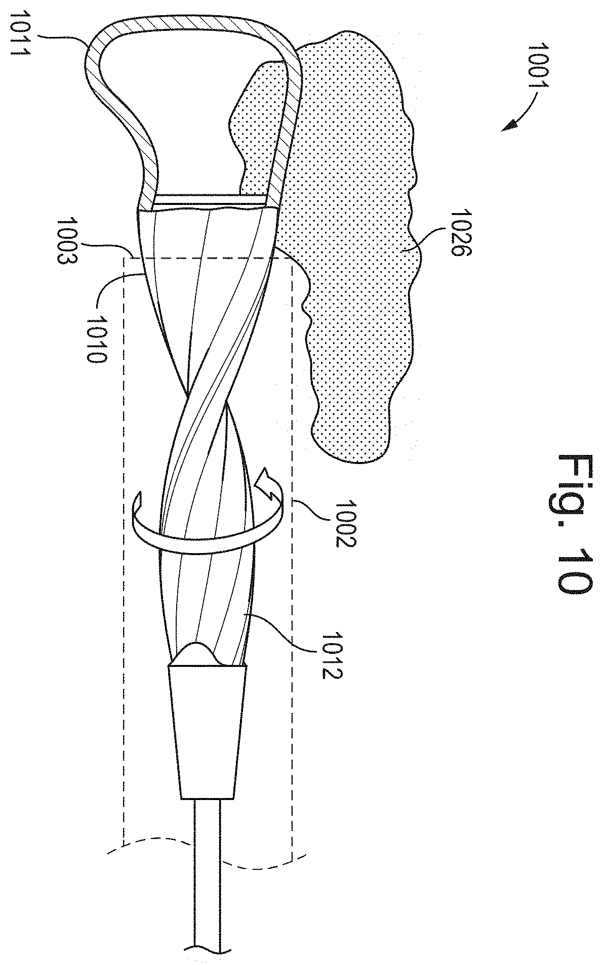 Patent US11793542 Figure 13 – Helical separator and methods of operating the same