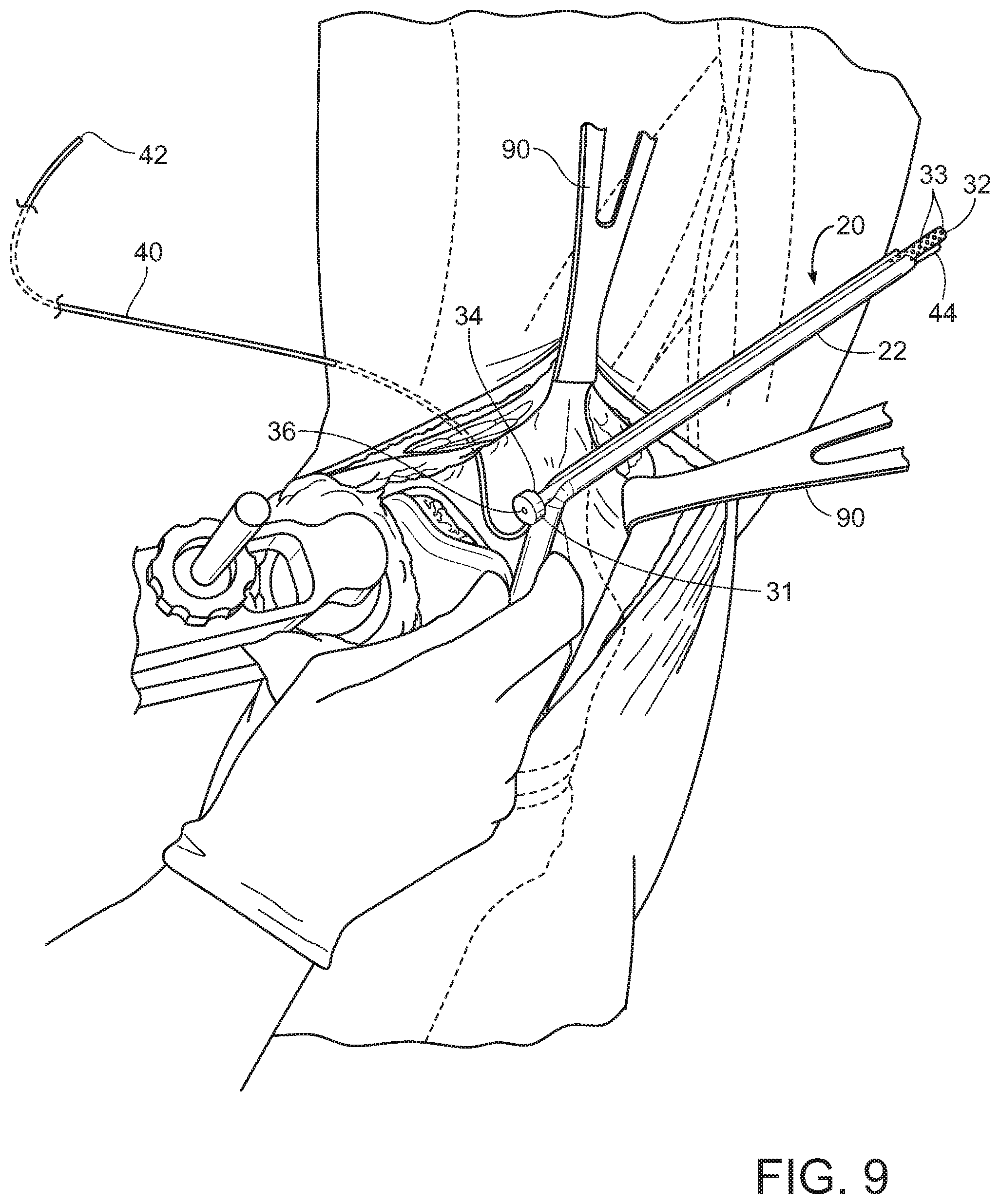 Patent US11793545 Figure 8 – Adductor canal block introducer