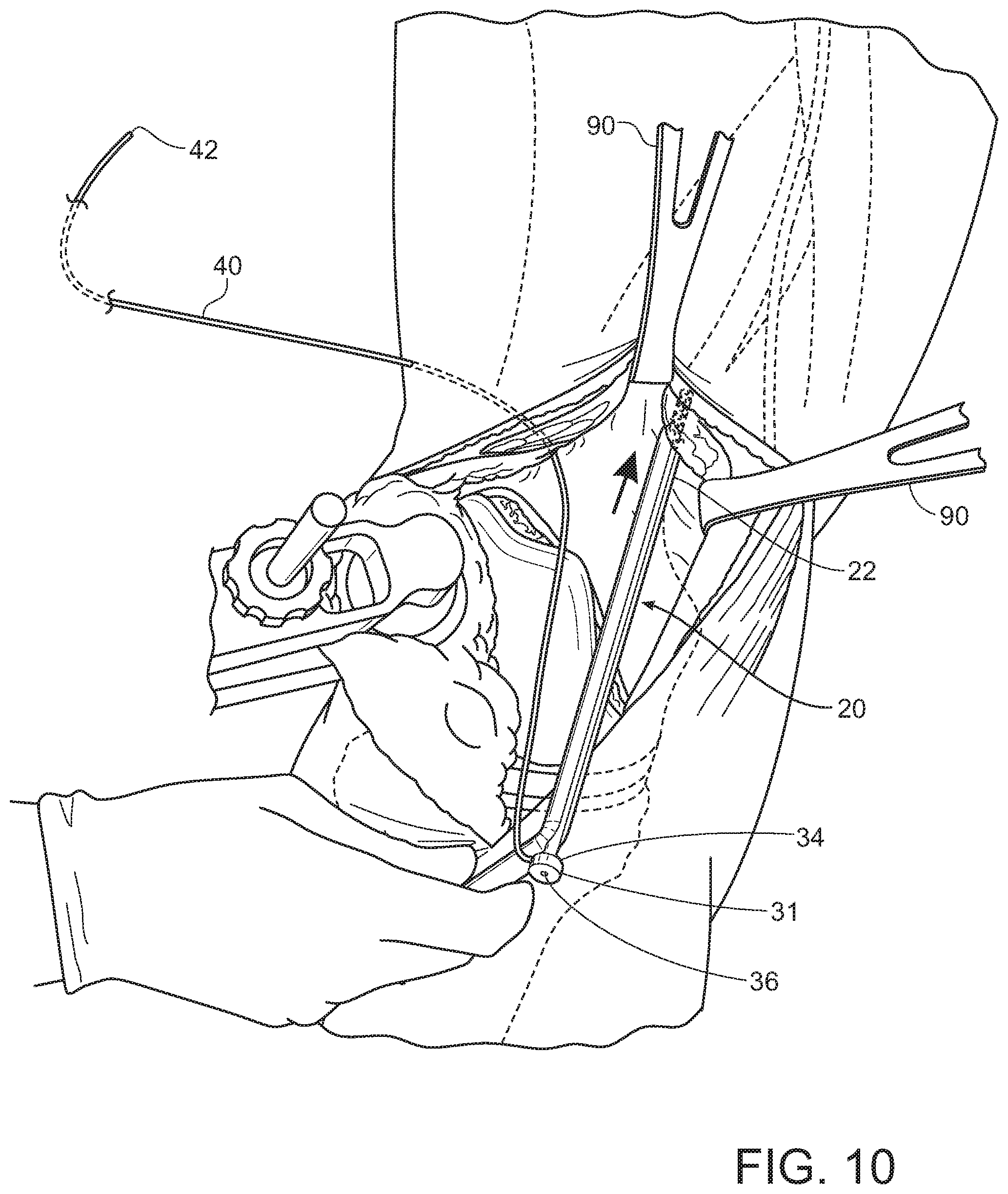 Patent US11793545 Figure 9 – Adductor canal block introducer