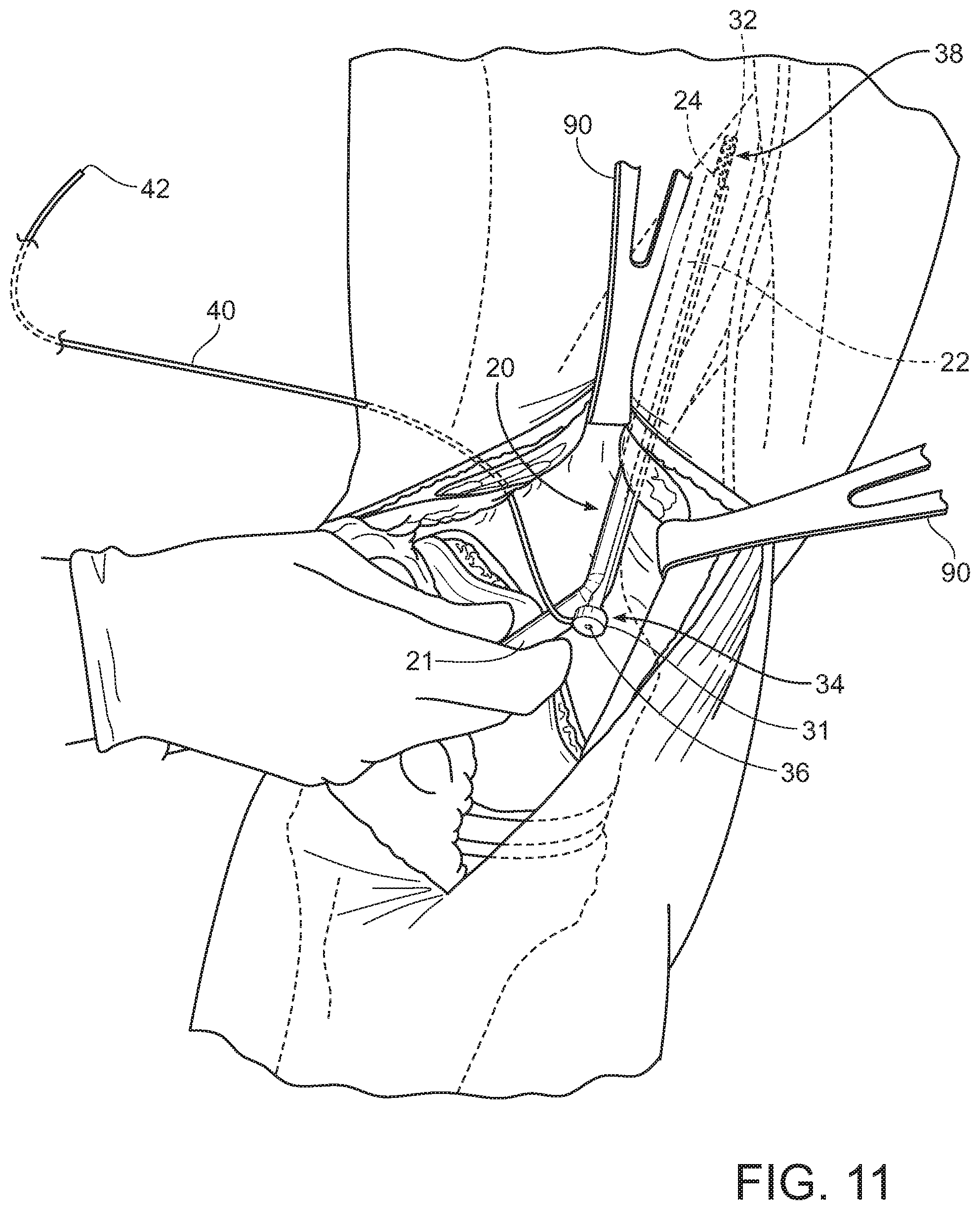 Patent US11793545 Figure 10 – Adductor canal block introducer