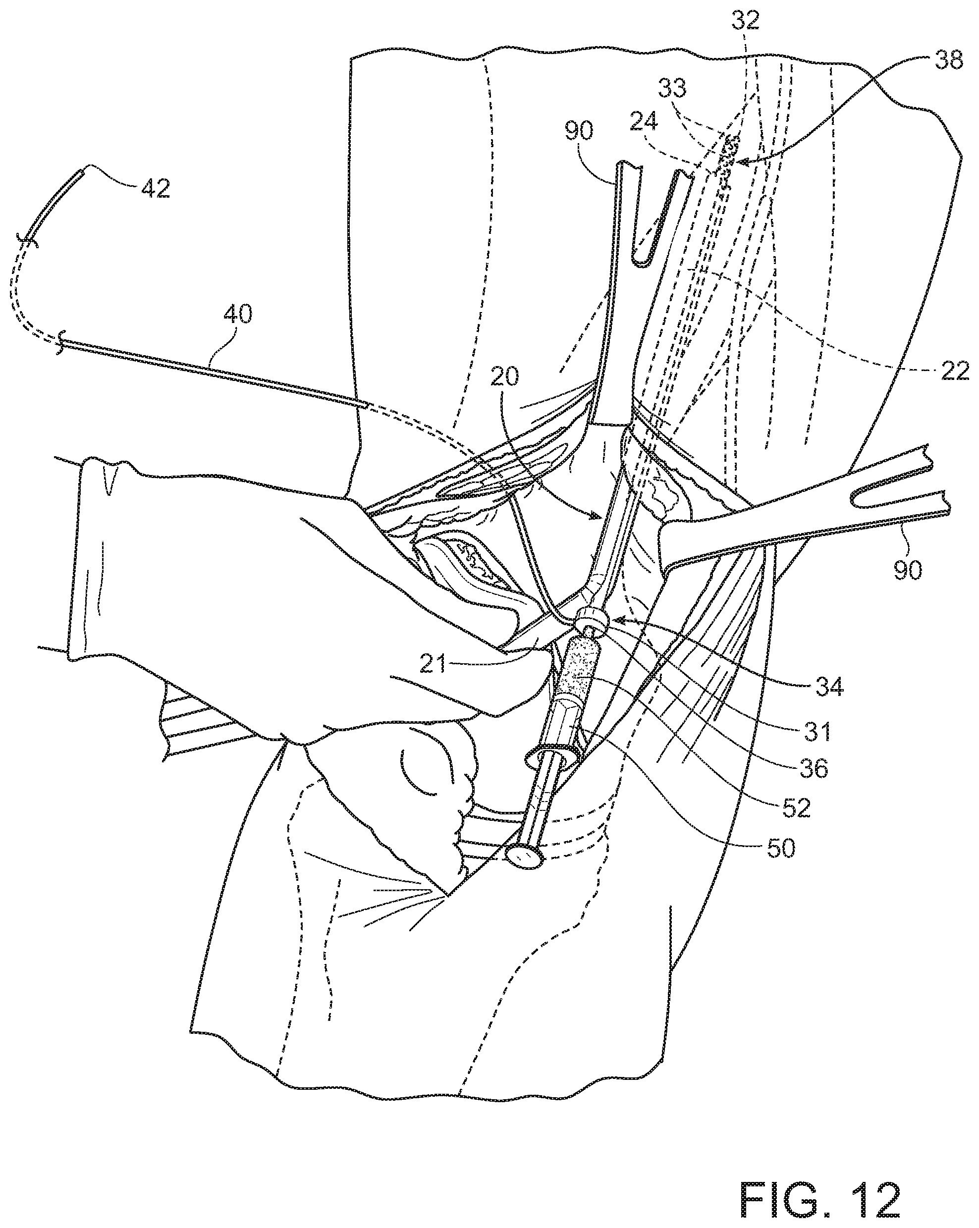 Patent US11793545 Figure 11 – Adductor canal block introducer