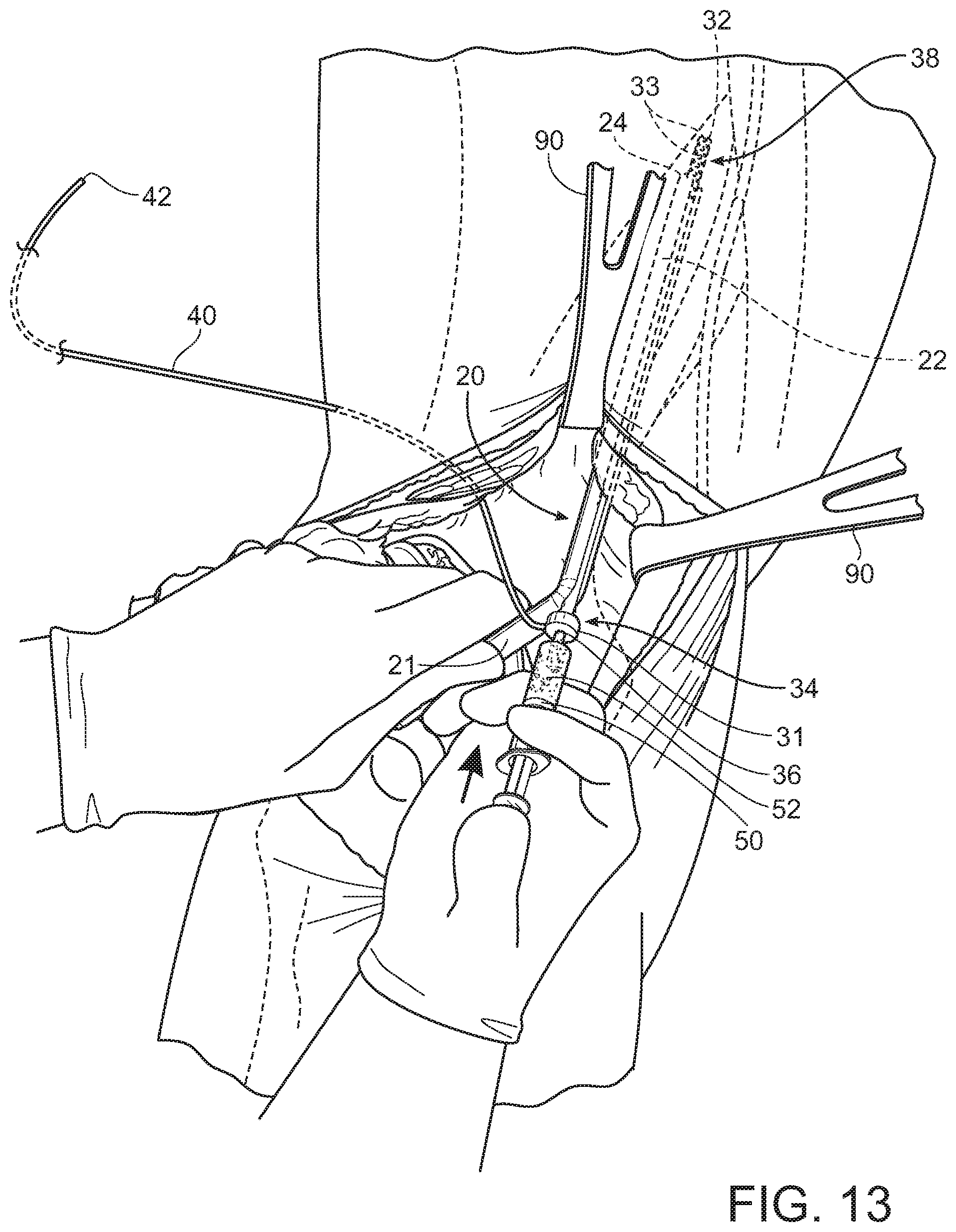 Patent US11793545 Figure 12 – Adductor canal block introducer