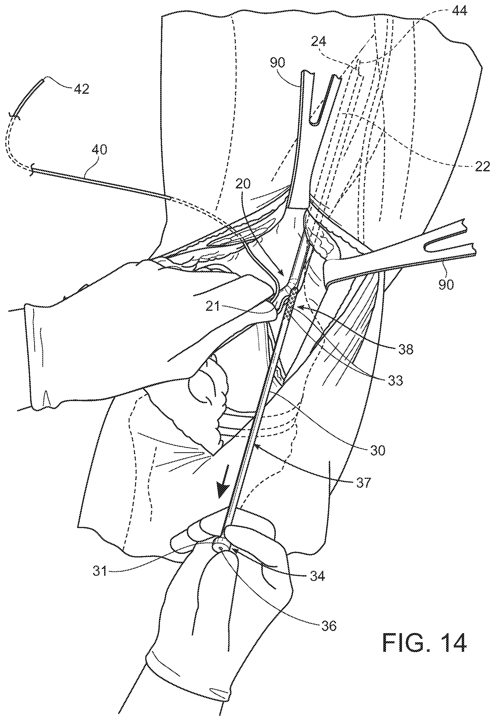 Patent US11793545 Figure 13 – Adductor canal block introducer