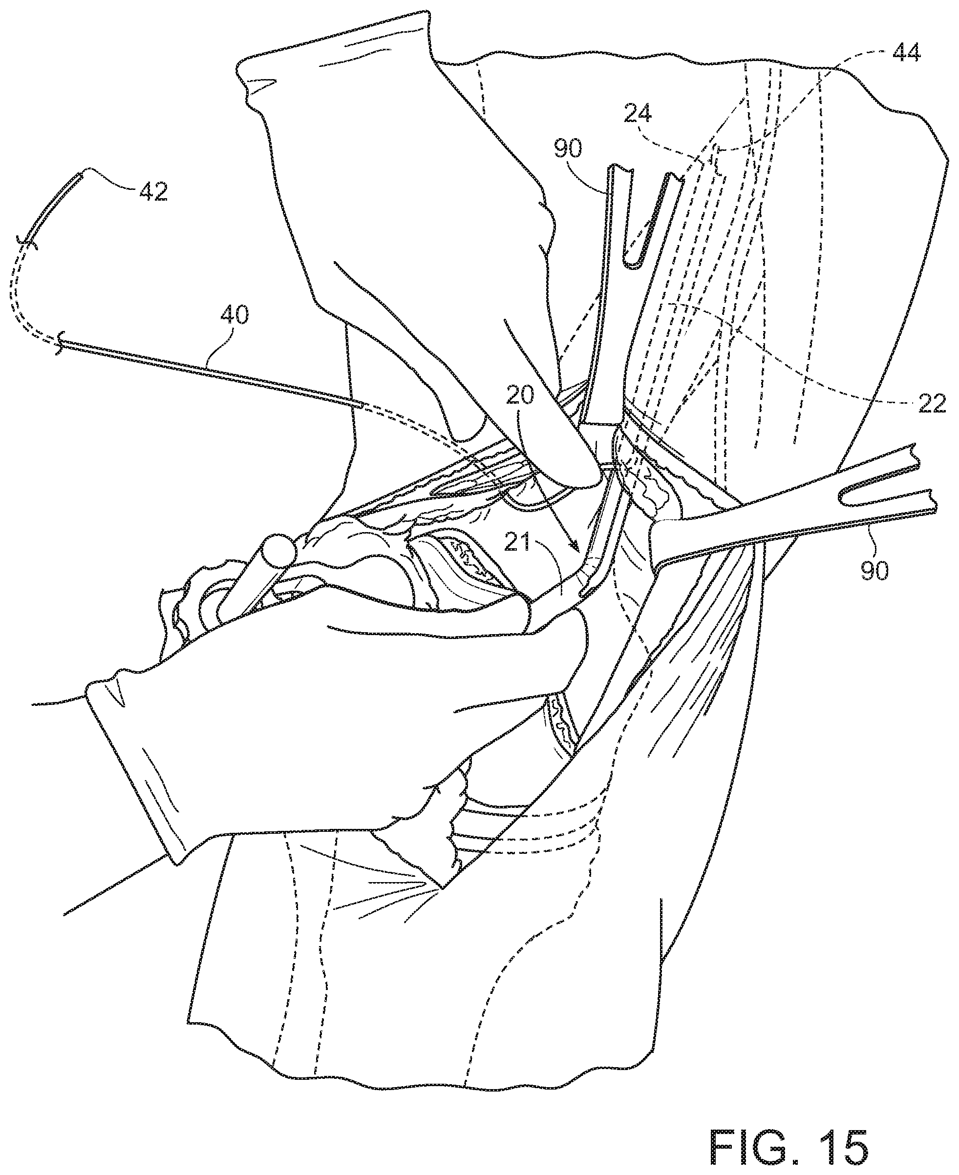 Patent US11793545 Figure 14 – Adductor canal block introducer
