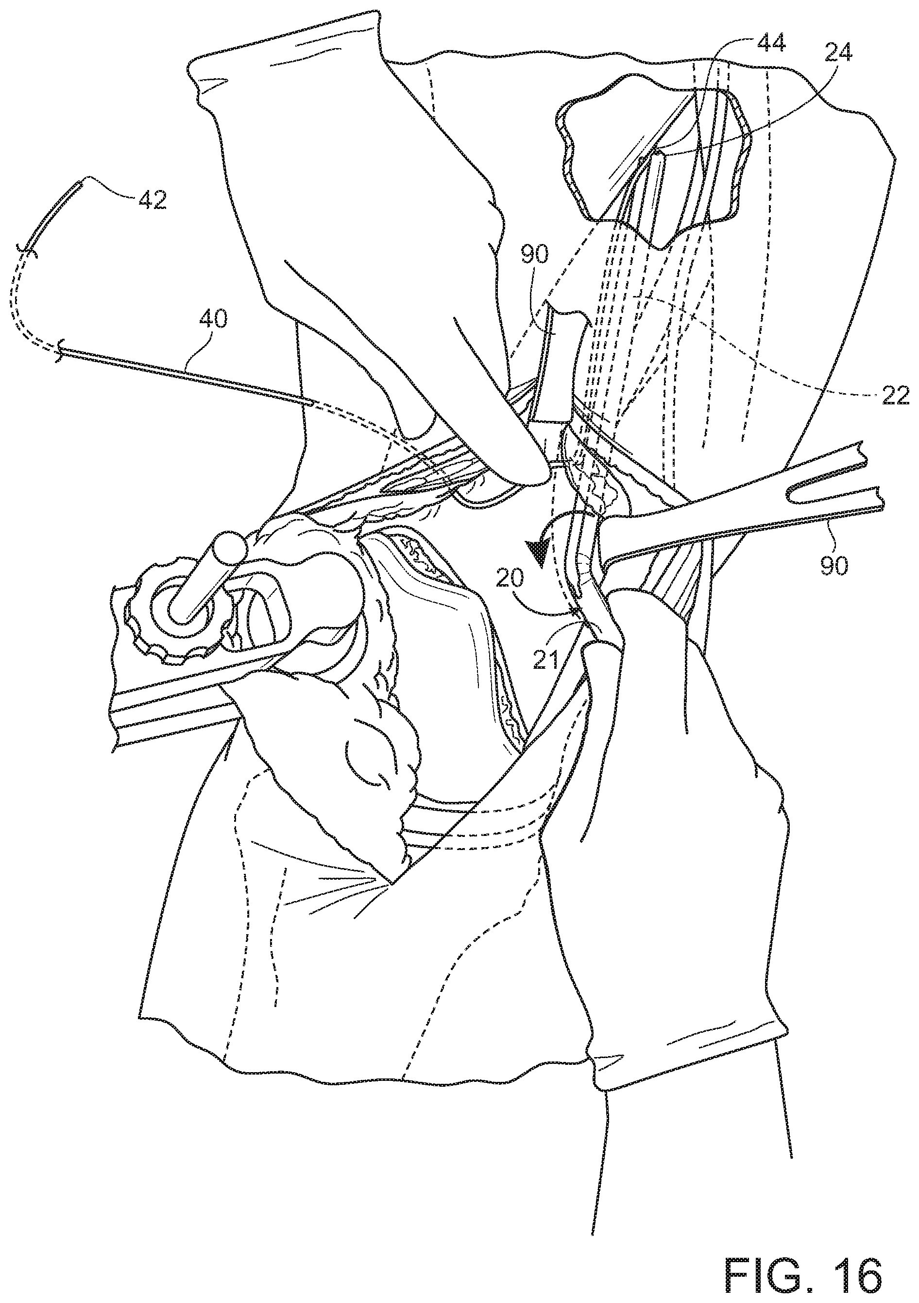 Patent US11793545 Figure 15 – Adductor canal block introducer