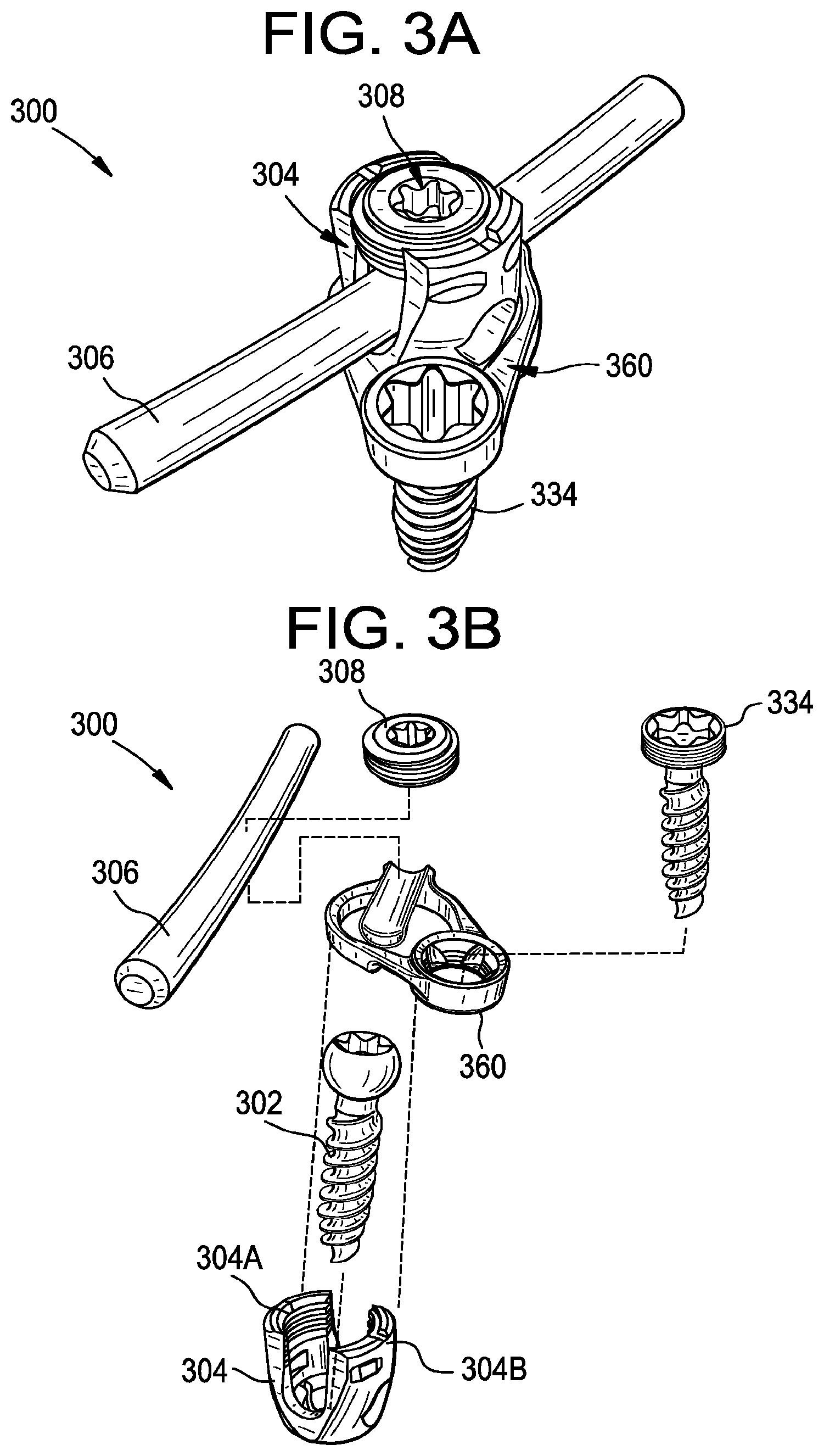 Patent US11793551 Figure 7 – Multipoint fixation implants