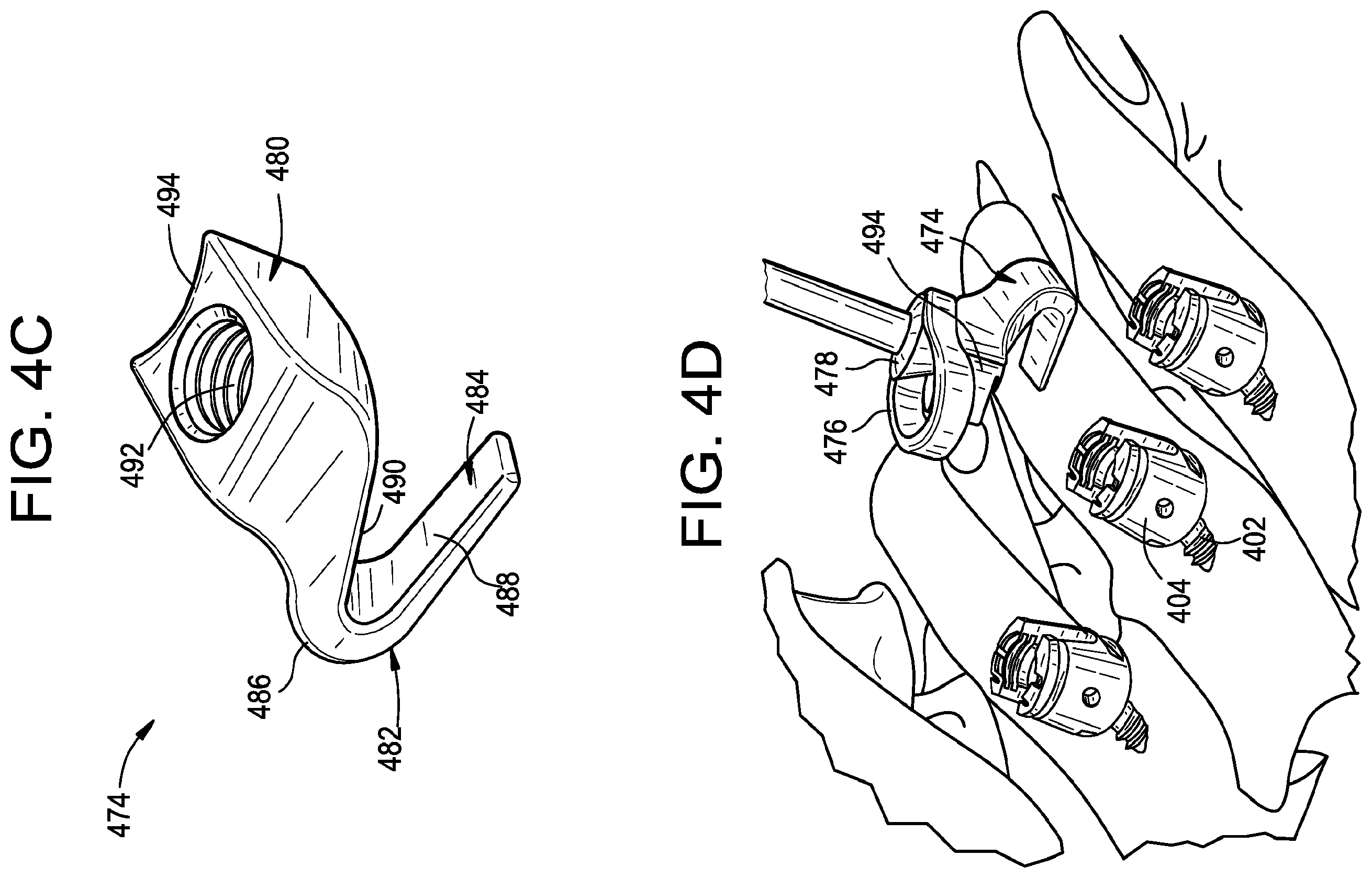 Patent US11793551 Figure 12 – Multipoint fixation implants