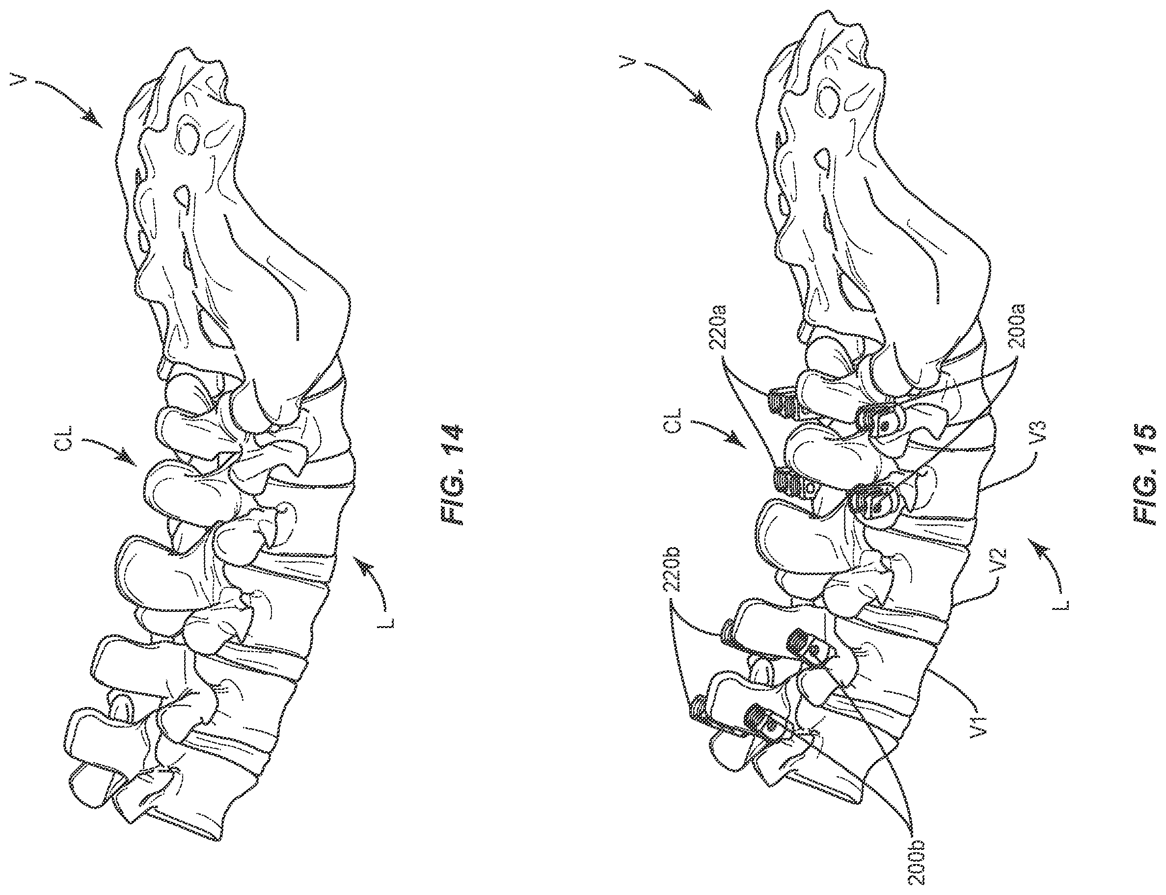 Patent US11793555 Figure 12 – Spinal correction system and method