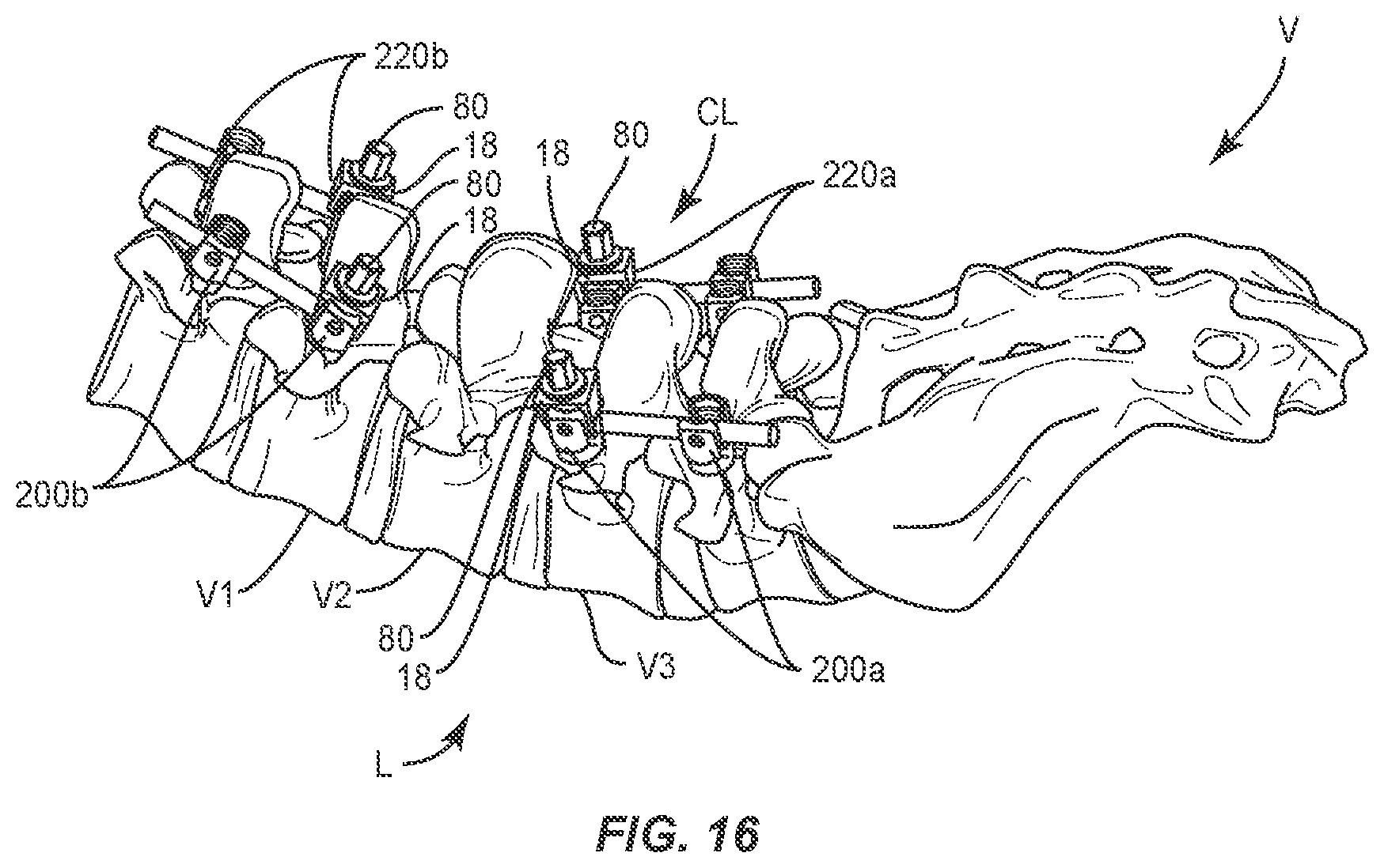Patent US11793555 Figure 13 – Spinal correction system and method