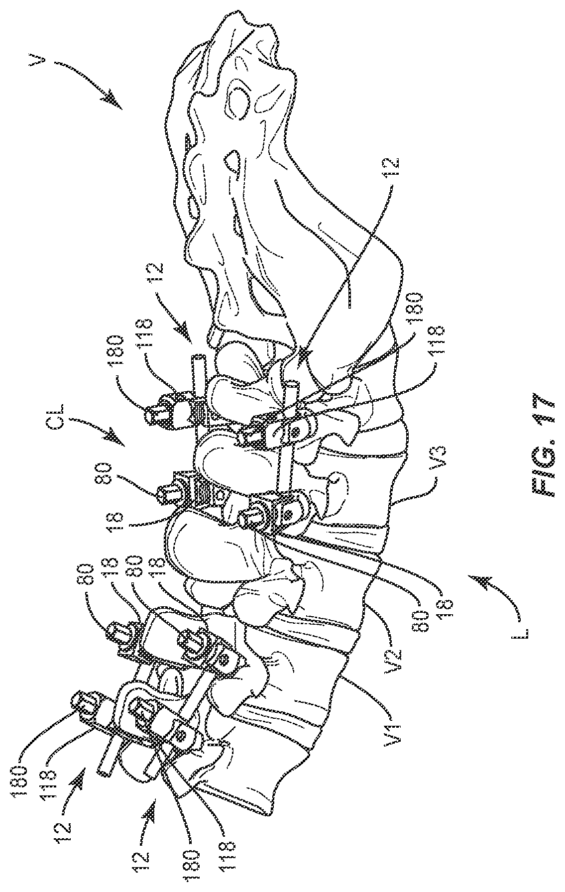 Patent US11793555 Figure 14 – Spinal correction system and method