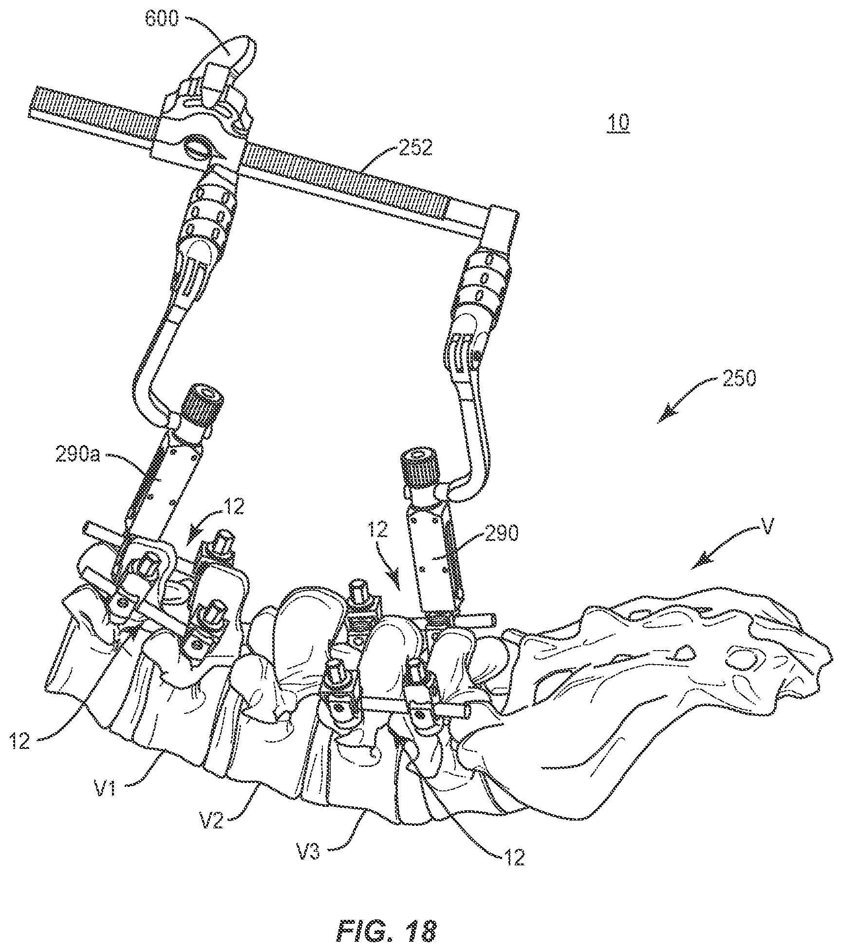 Patent US11793555 Figure 15 – Spinal correction system and method