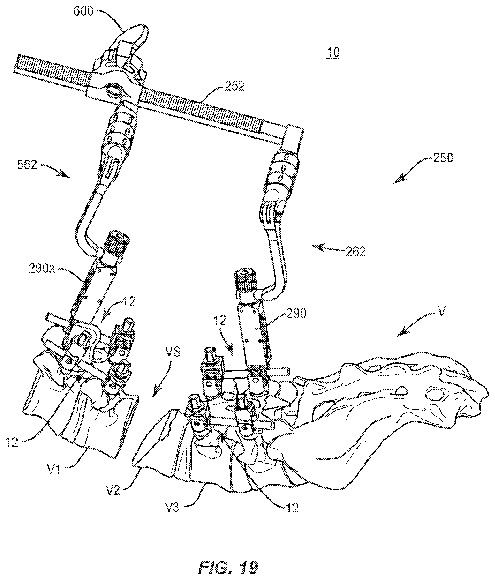 Patent US11793555 Figure 16 – Spinal correction system and method