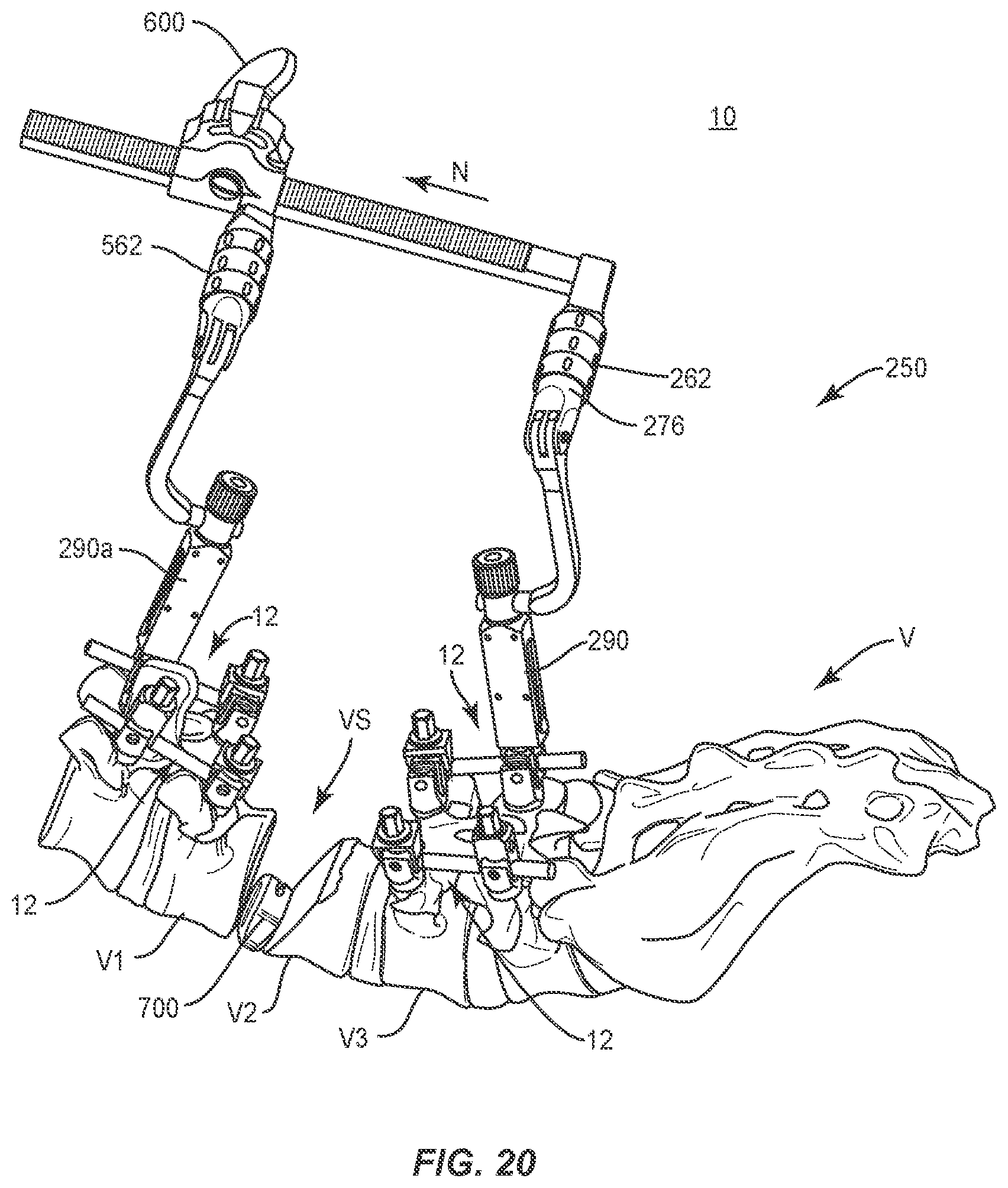 Patent US11793555 Figure 17 – Spinal correction system and method