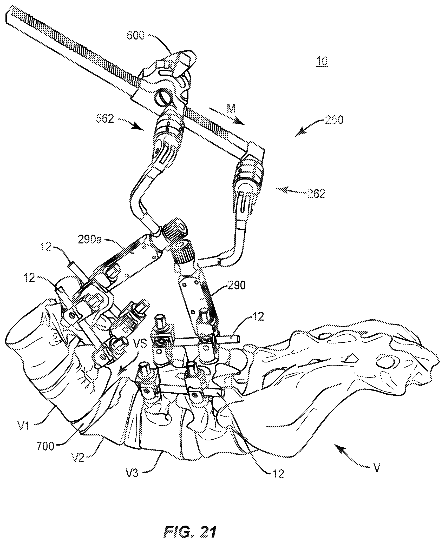 Patent US11793555 Figure 18 – Spinal correction system and method