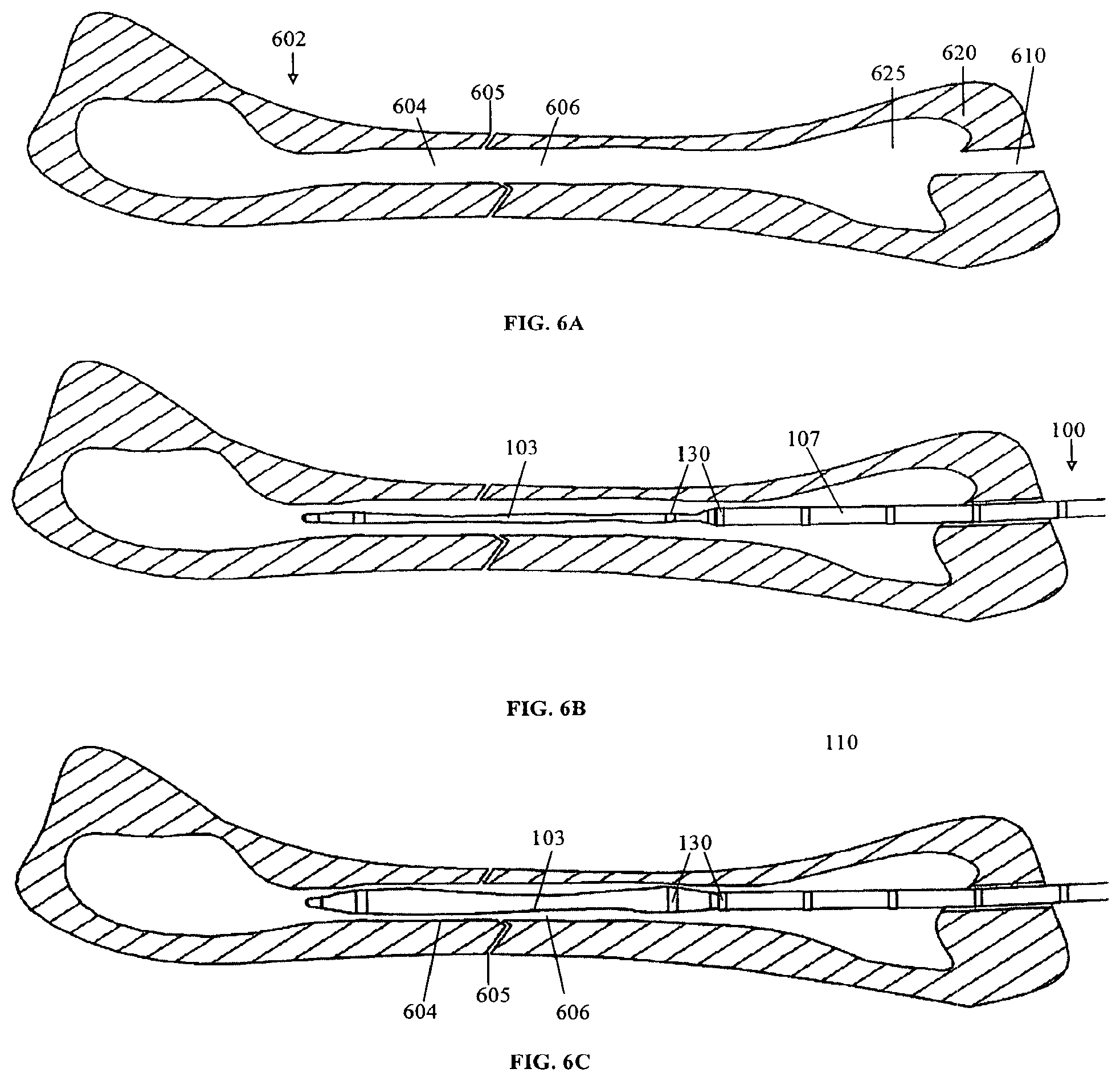 Patent US11793556 Figure 9 – Systems and methods for internal bone fixation