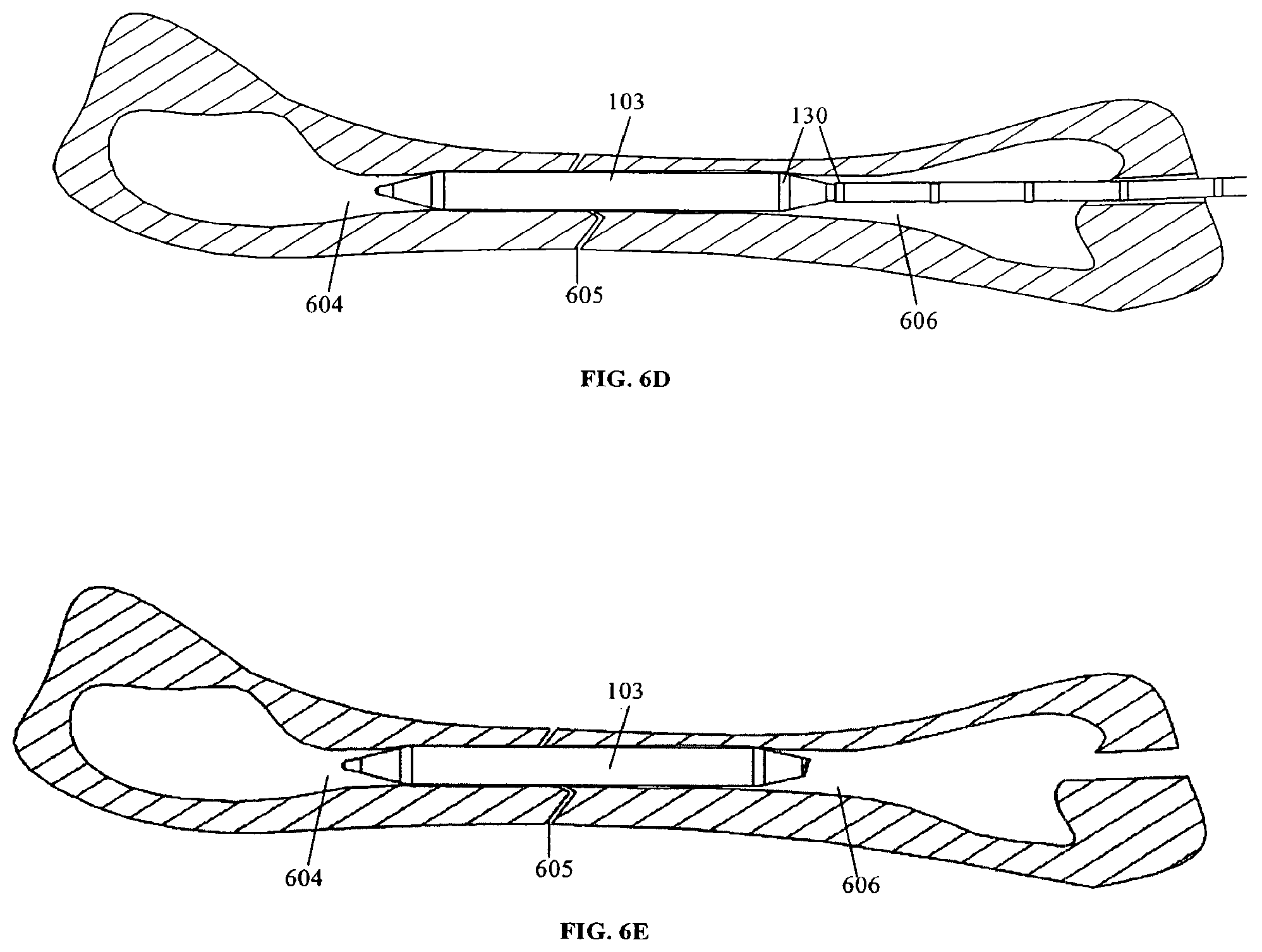 Patent US11793556 Figure 10 – Systems and methods for internal bone fixation