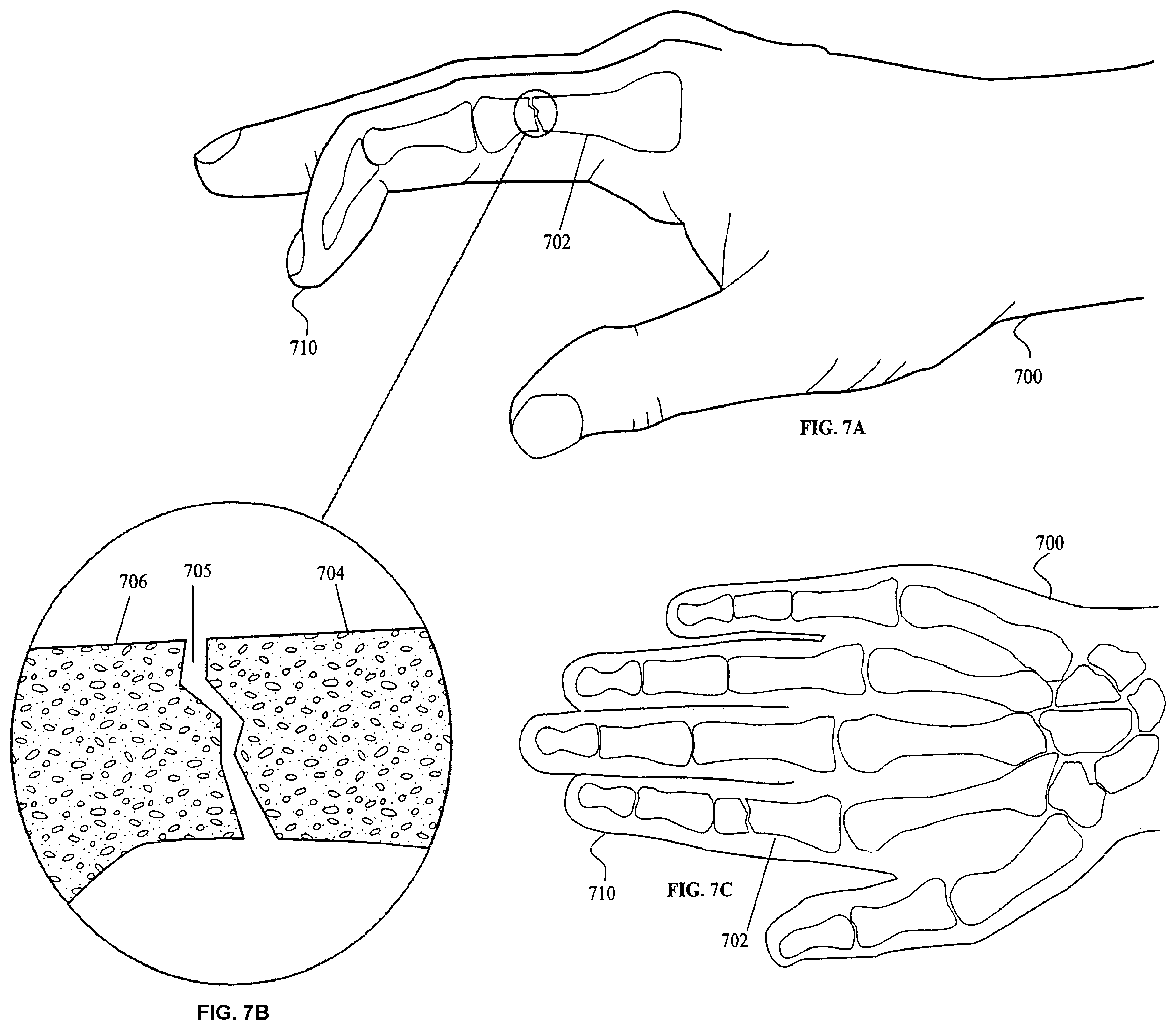 Patent US11793556 Figure 11 – Systems and methods for internal bone fixation