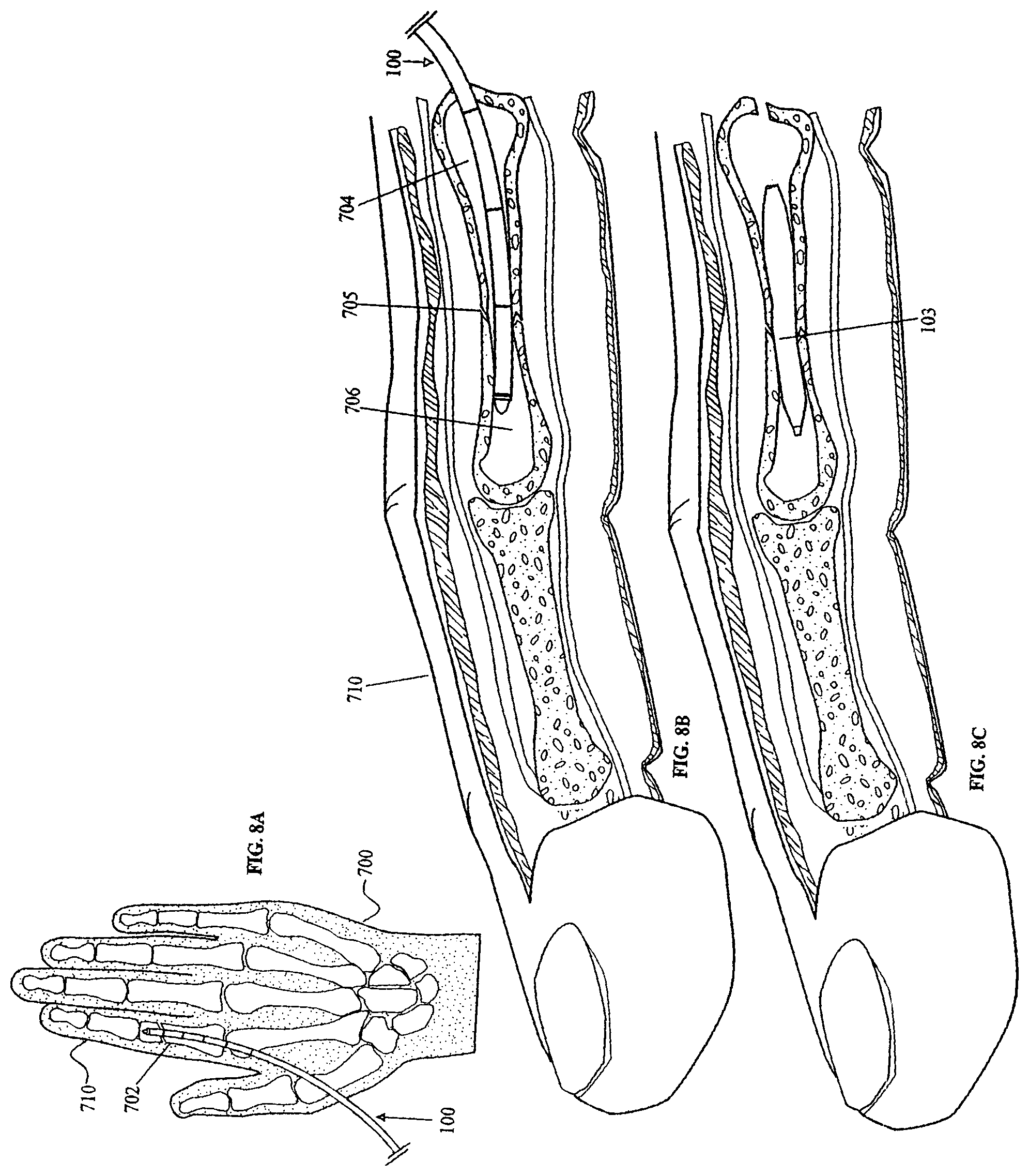 Patent US11793556 Figure 12 – Systems and methods for internal bone fixation