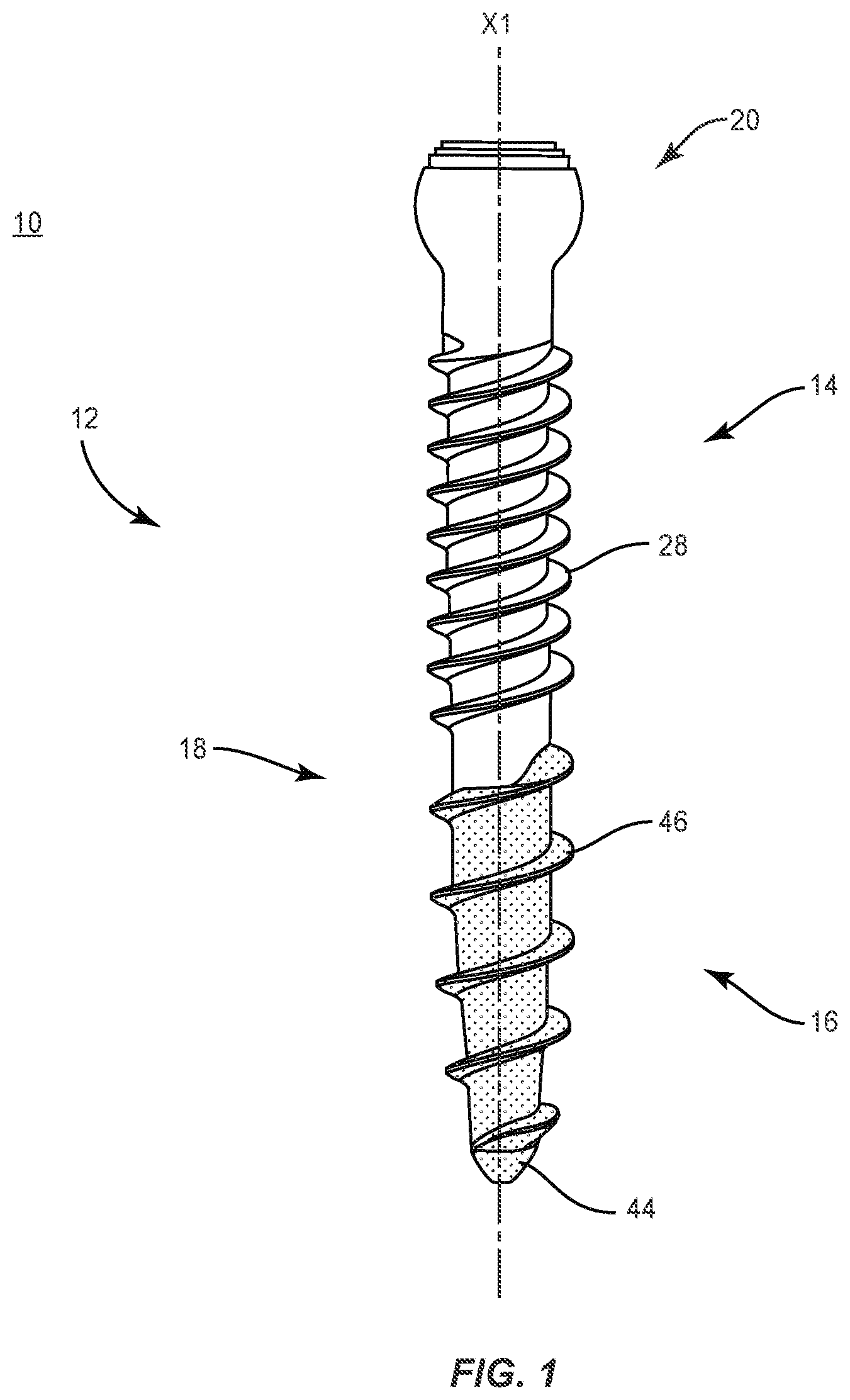 Patent US11793557 Figure 1 – System and method of manufacture for spinal implant
