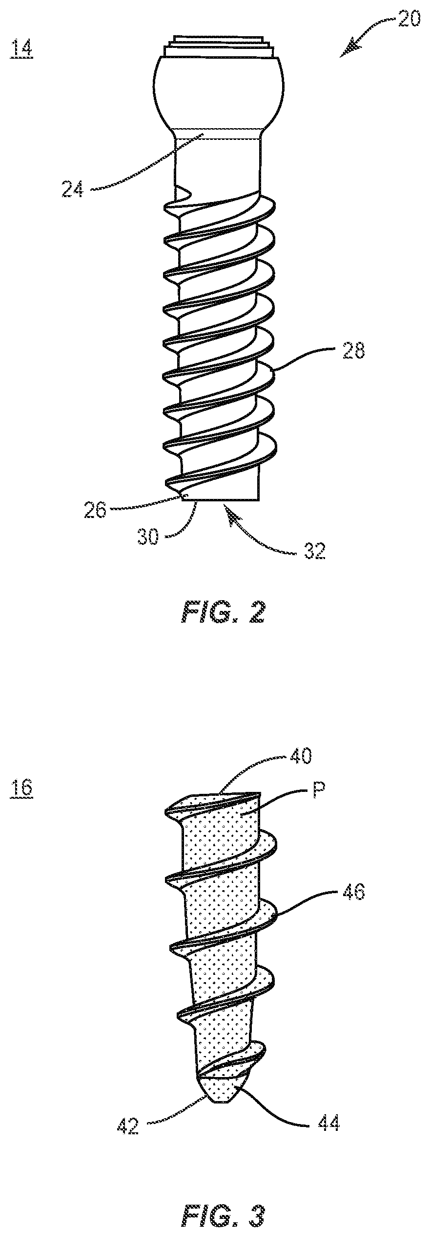 Patent US11793557 Figure 2 – System and method of manufacture for spinal implant