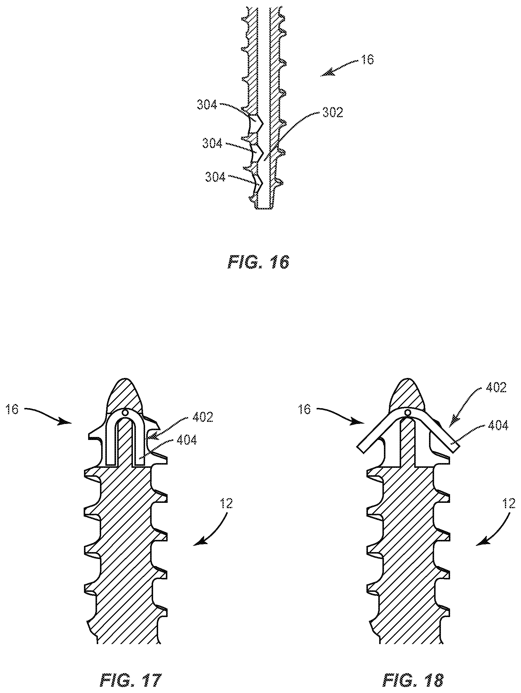 Patent US11793557 Figure 11 – System and method of manufacture for spinal implant