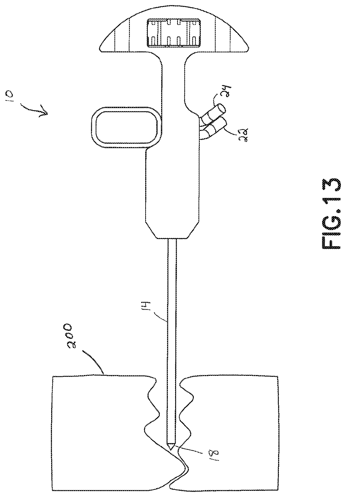Patent US11793560 Figure 12 – Directional kyphoplasty device and method of using such a device