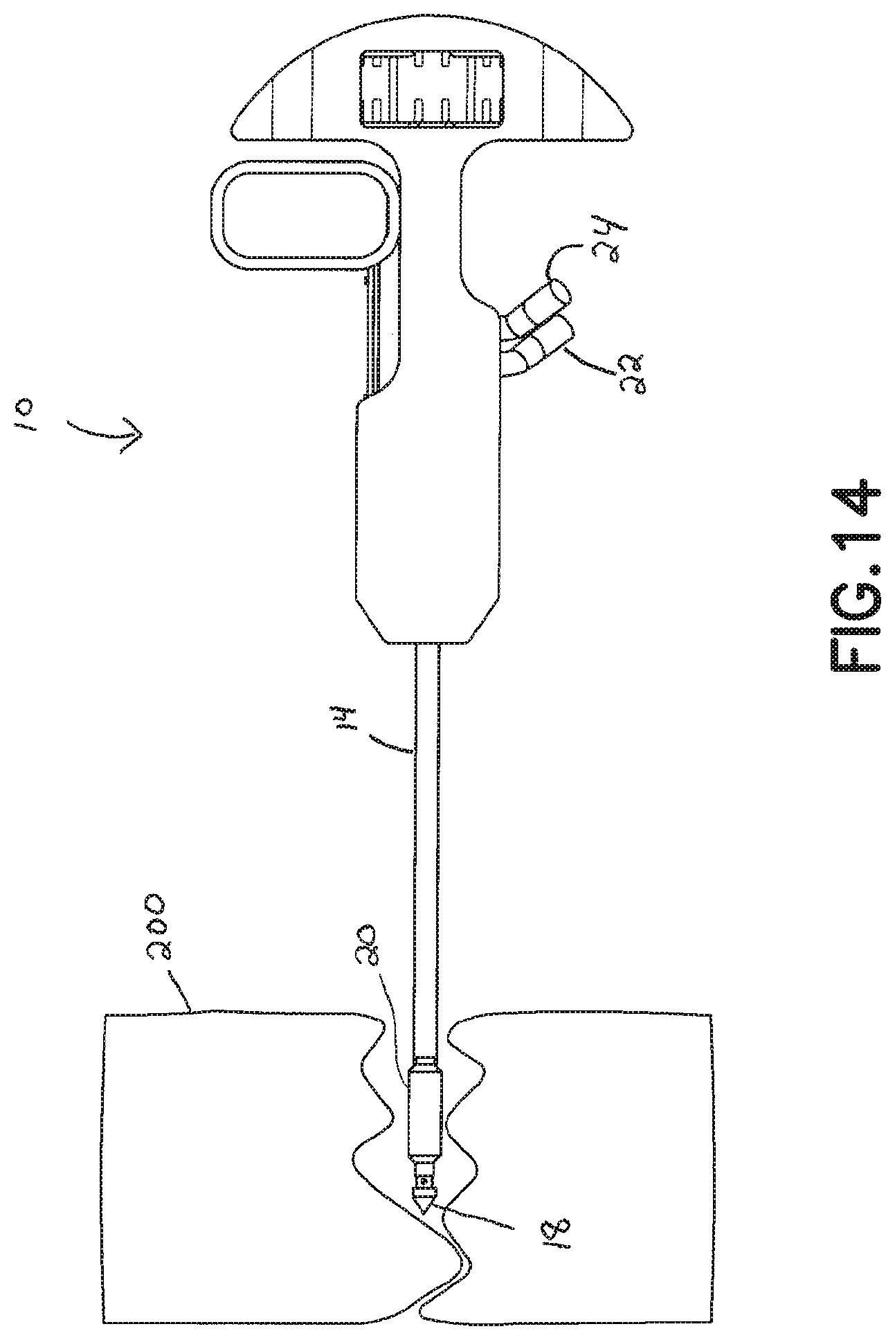 Patent US11793560 Figure 13 – Directional kyphoplasty device and method of using such a device