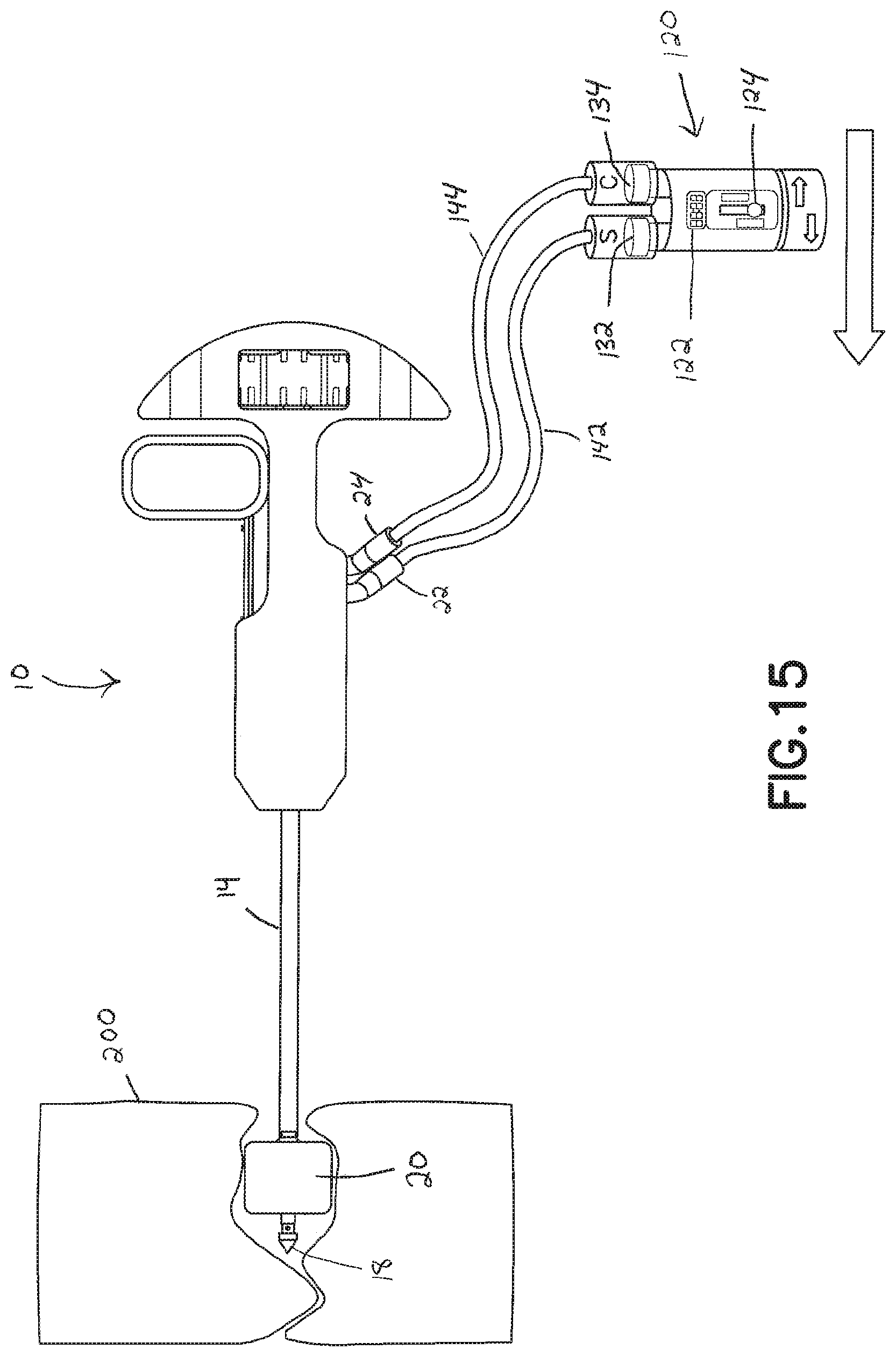 Patent US11793560 Figure 14 – Directional kyphoplasty device and method of using such a device