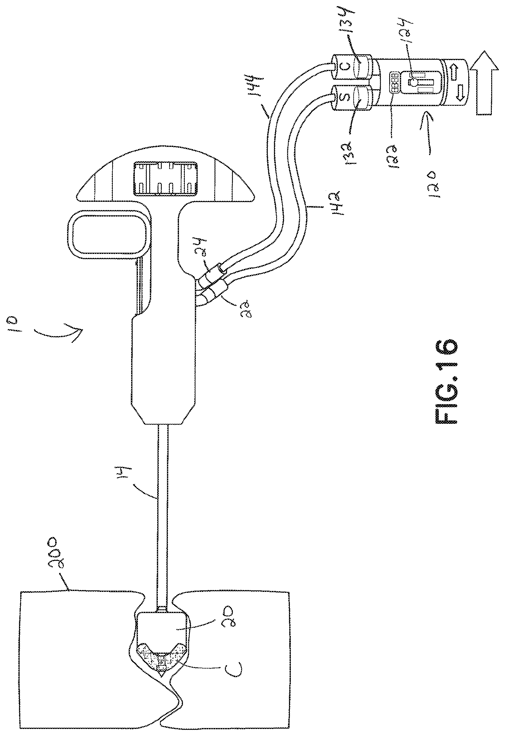 Patent US11793560 Figure 15 – Directional kyphoplasty device and method of using such a device