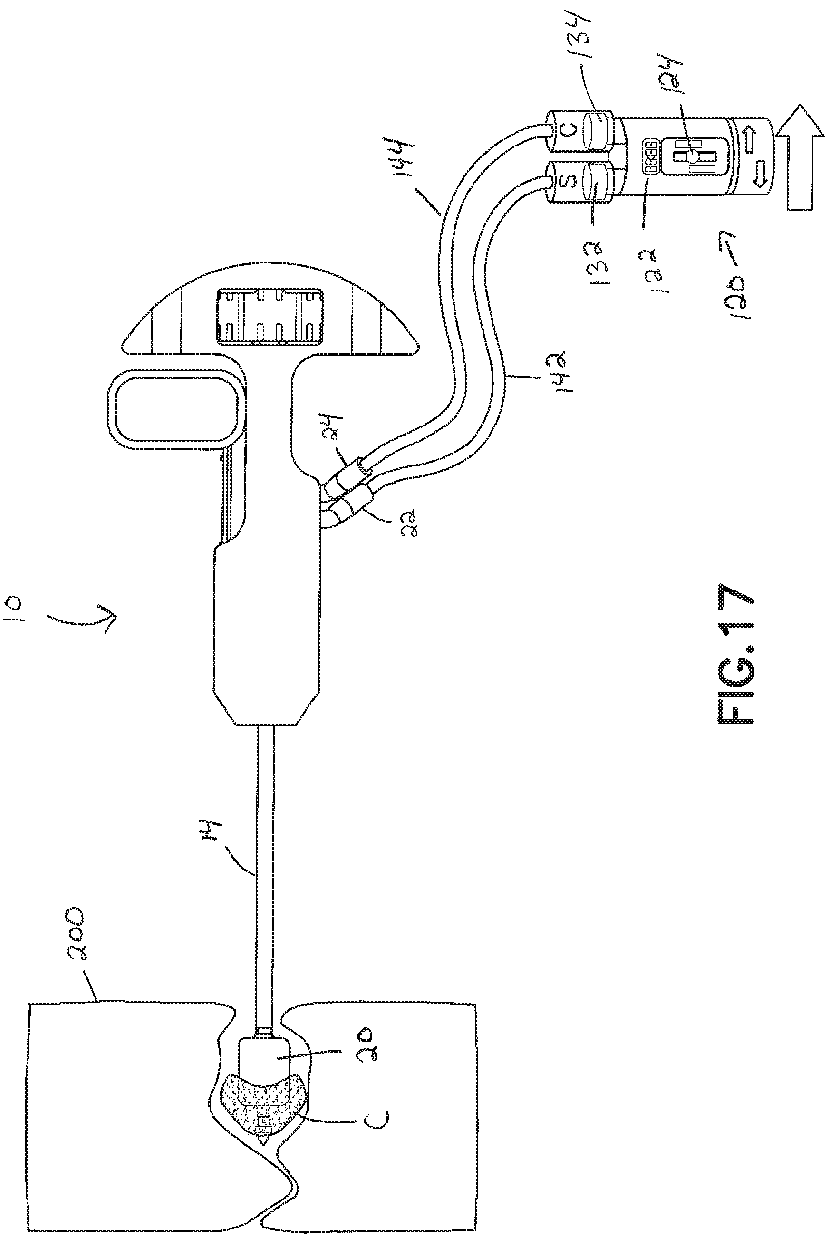 Patent US11793560 Figure 16 – Directional kyphoplasty device and method of using such a device