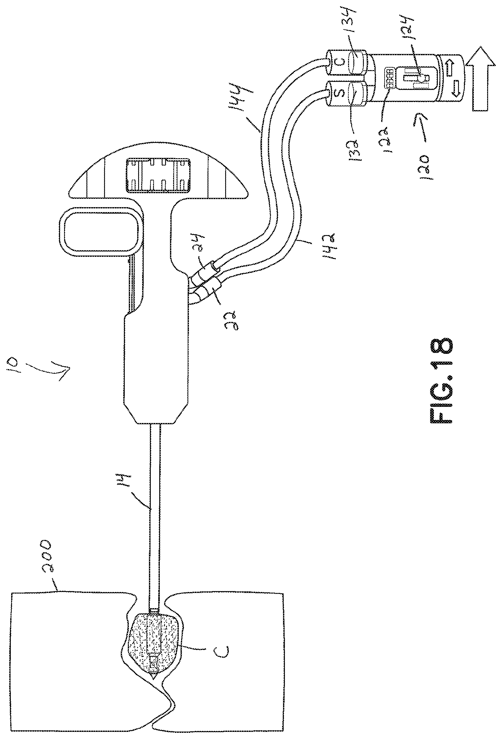 Patent US11793560 Figure 17 – Directional kyphoplasty device and method of using such a device