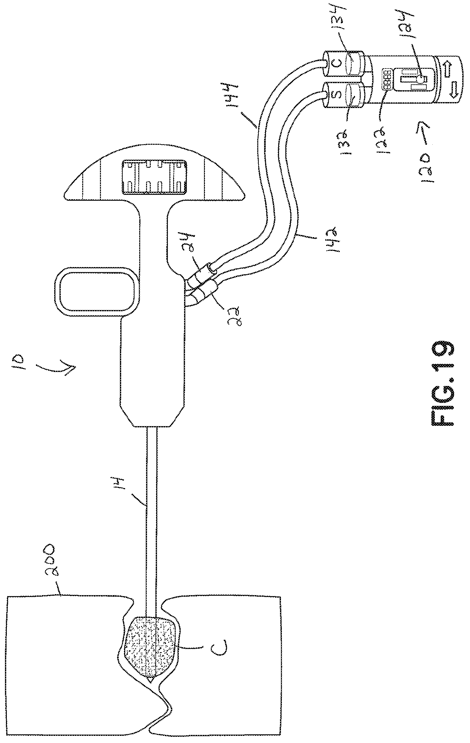 Patent US11793560 Figure 18 – Directional kyphoplasty device and method of using such a device