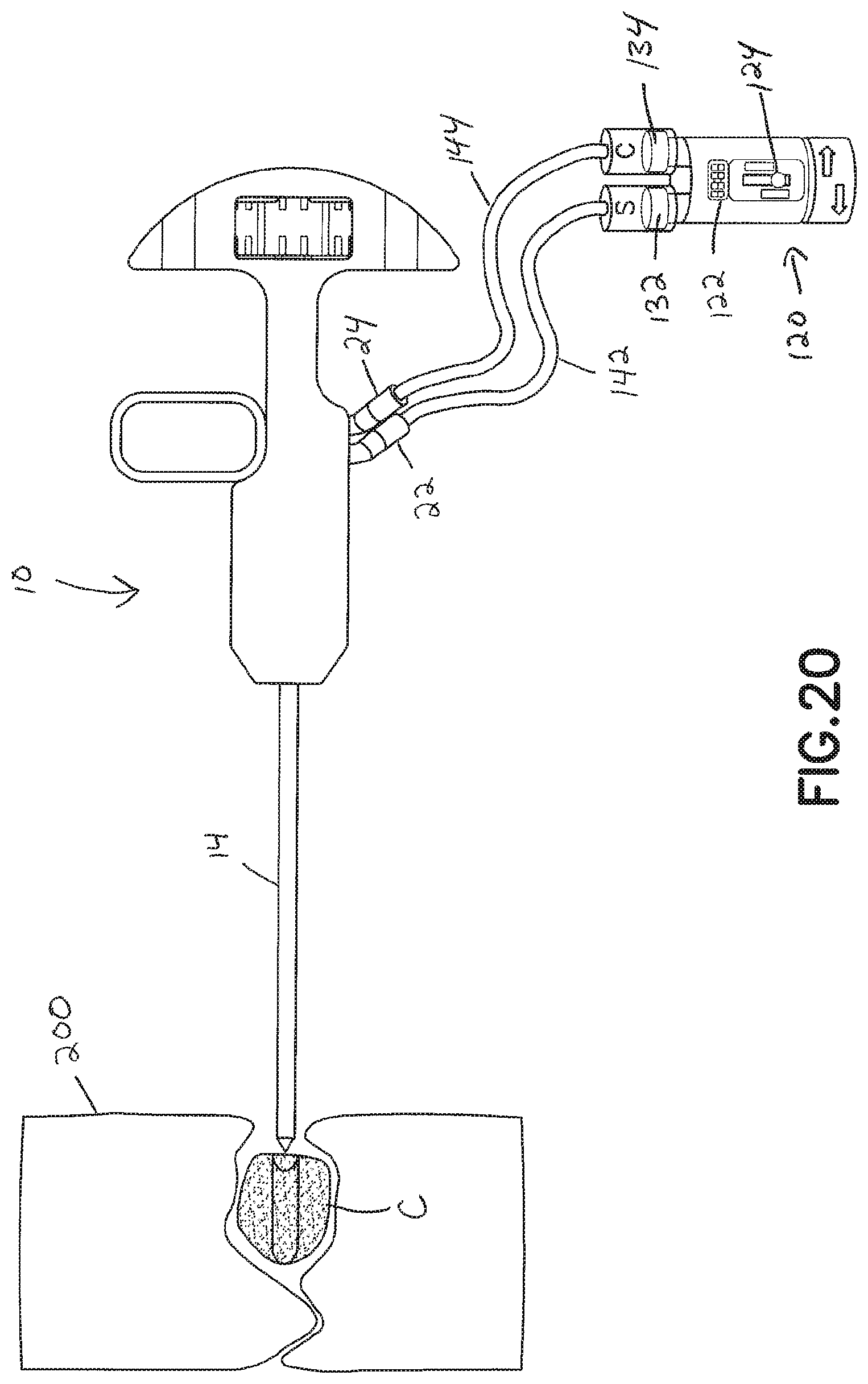 Patent US11793560 Figure 19 – Directional kyphoplasty device and method of using such a device