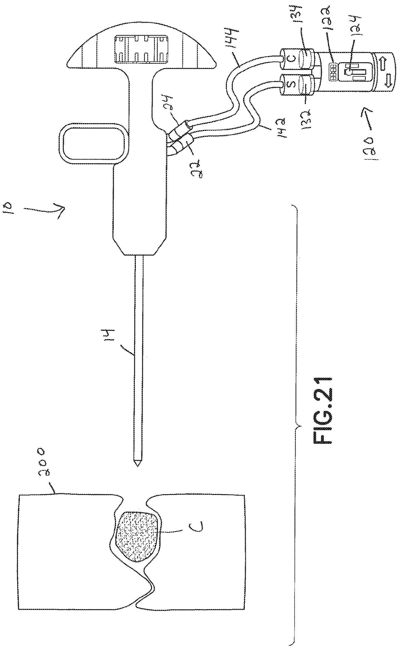 Patent US11793560 Figure 20 – Directional kyphoplasty device and method of using such a device