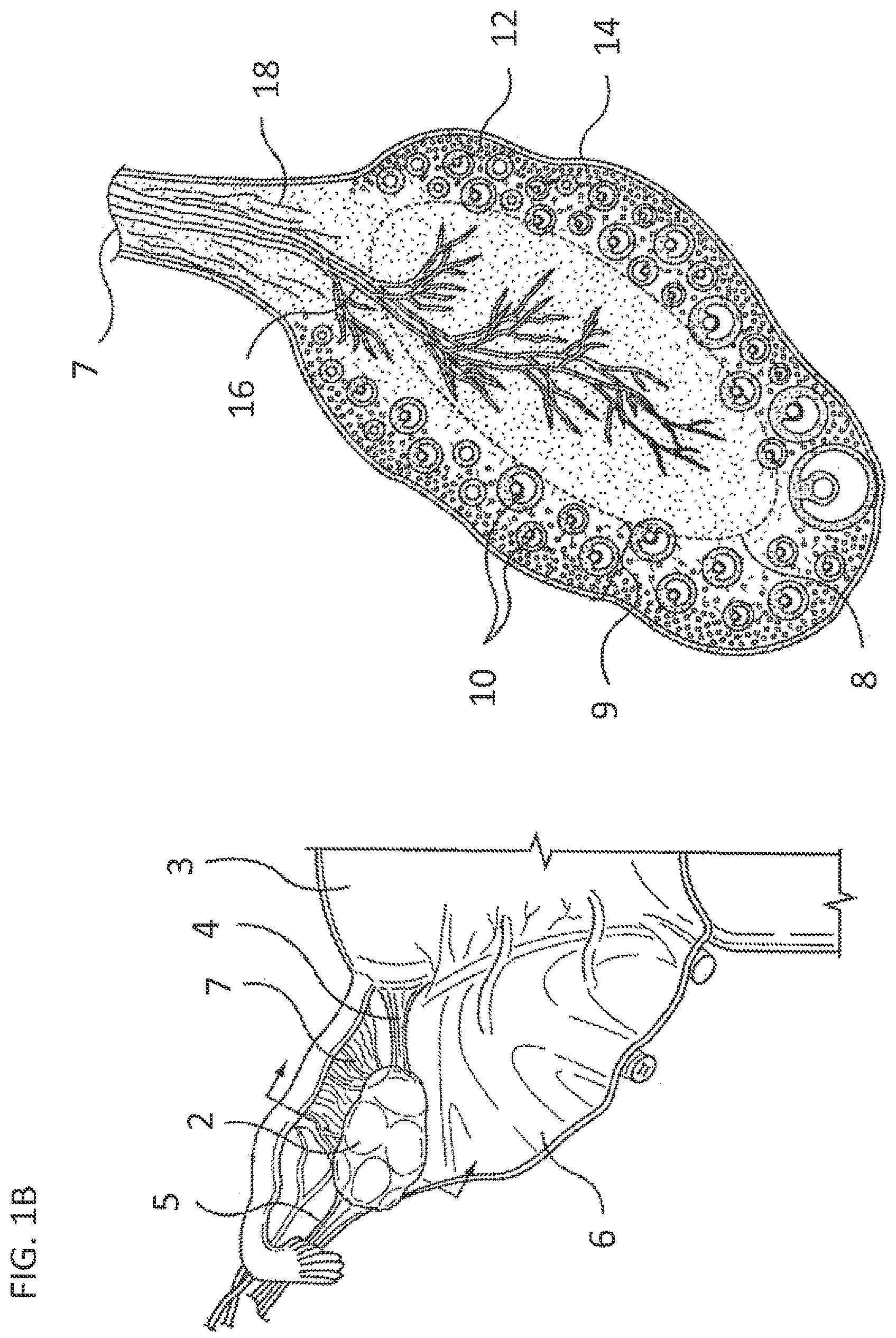 Patent US11793564 Figure 2 – Methods and systems for the treatment of polycystic ovary syndrome