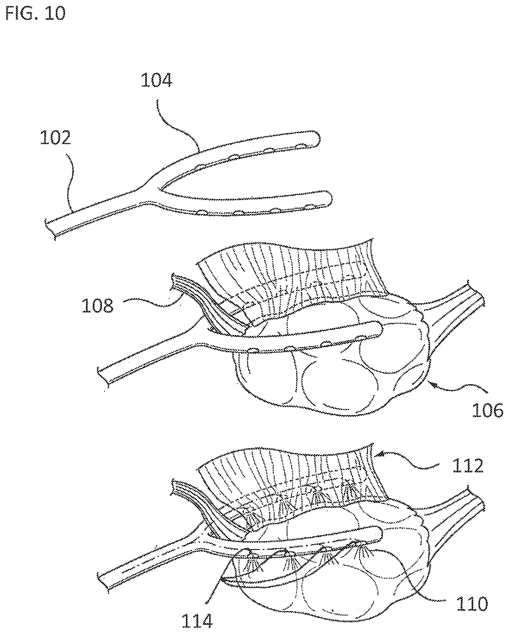 Patent US11793564 Figure 5 – Methods and systems for the treatment of polycystic ovary syndrome