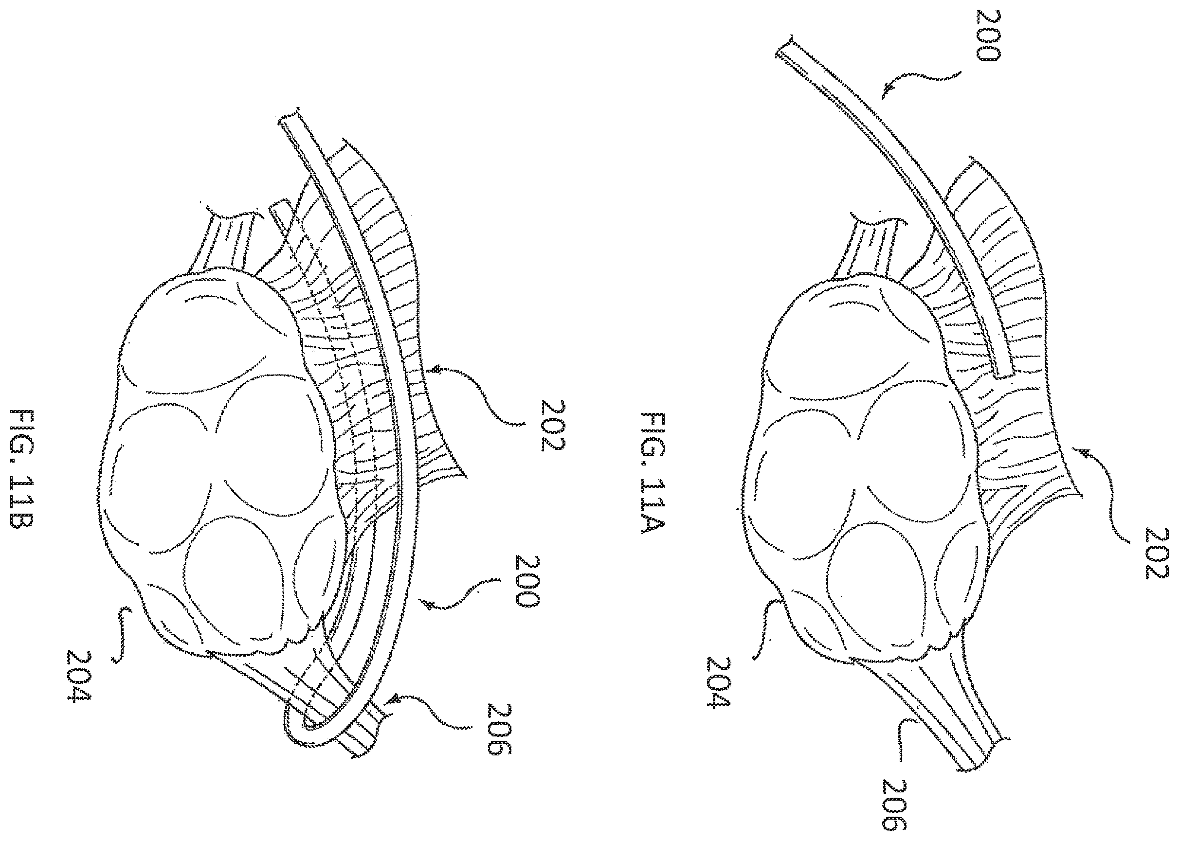 Patent US11793564 Figure 6 – Methods and systems for the treatment of polycystic ovary syndrome