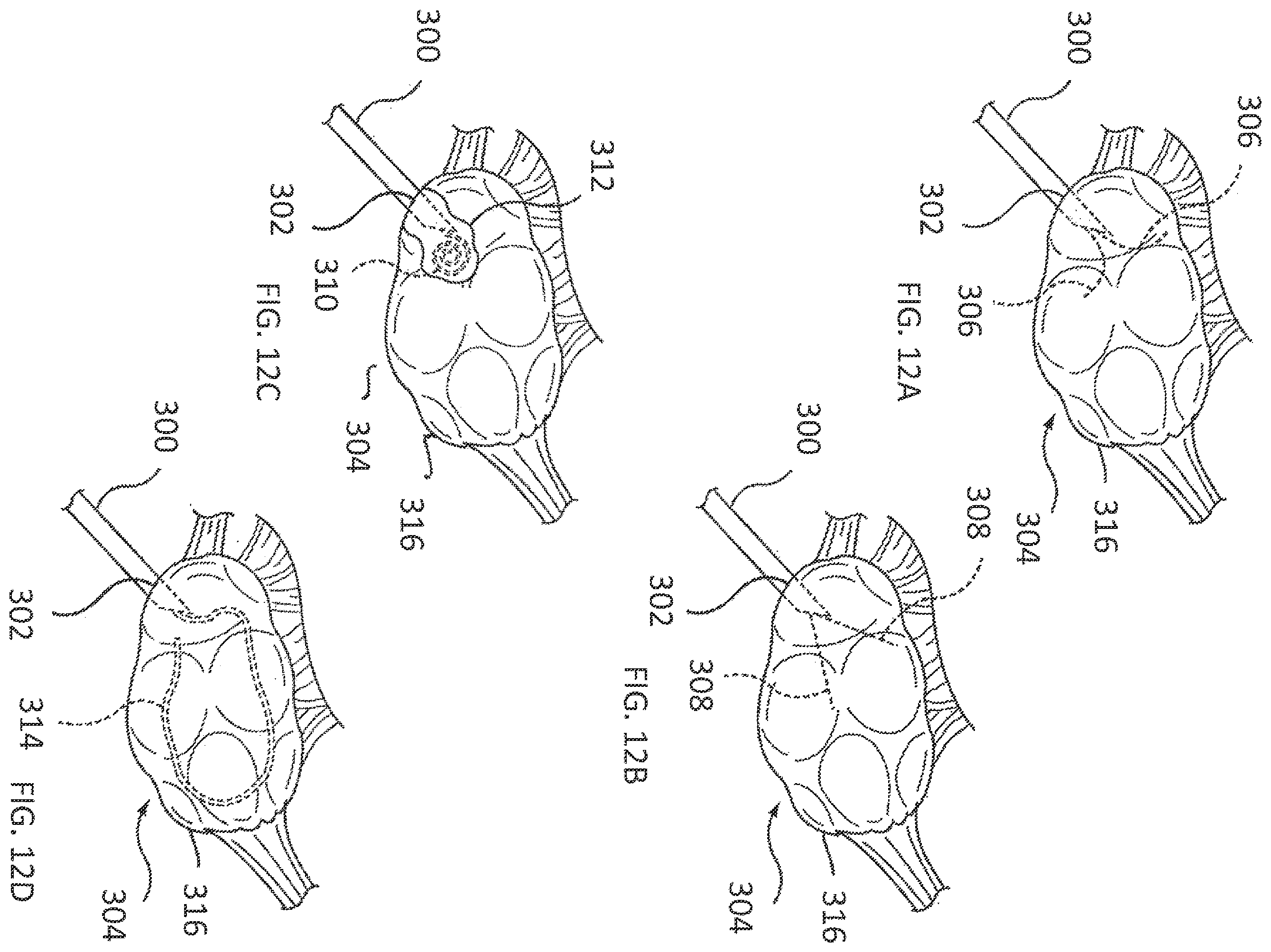 Patent US11793564 Figure 7 – Methods and systems for the treatment of polycystic ovary syndrome