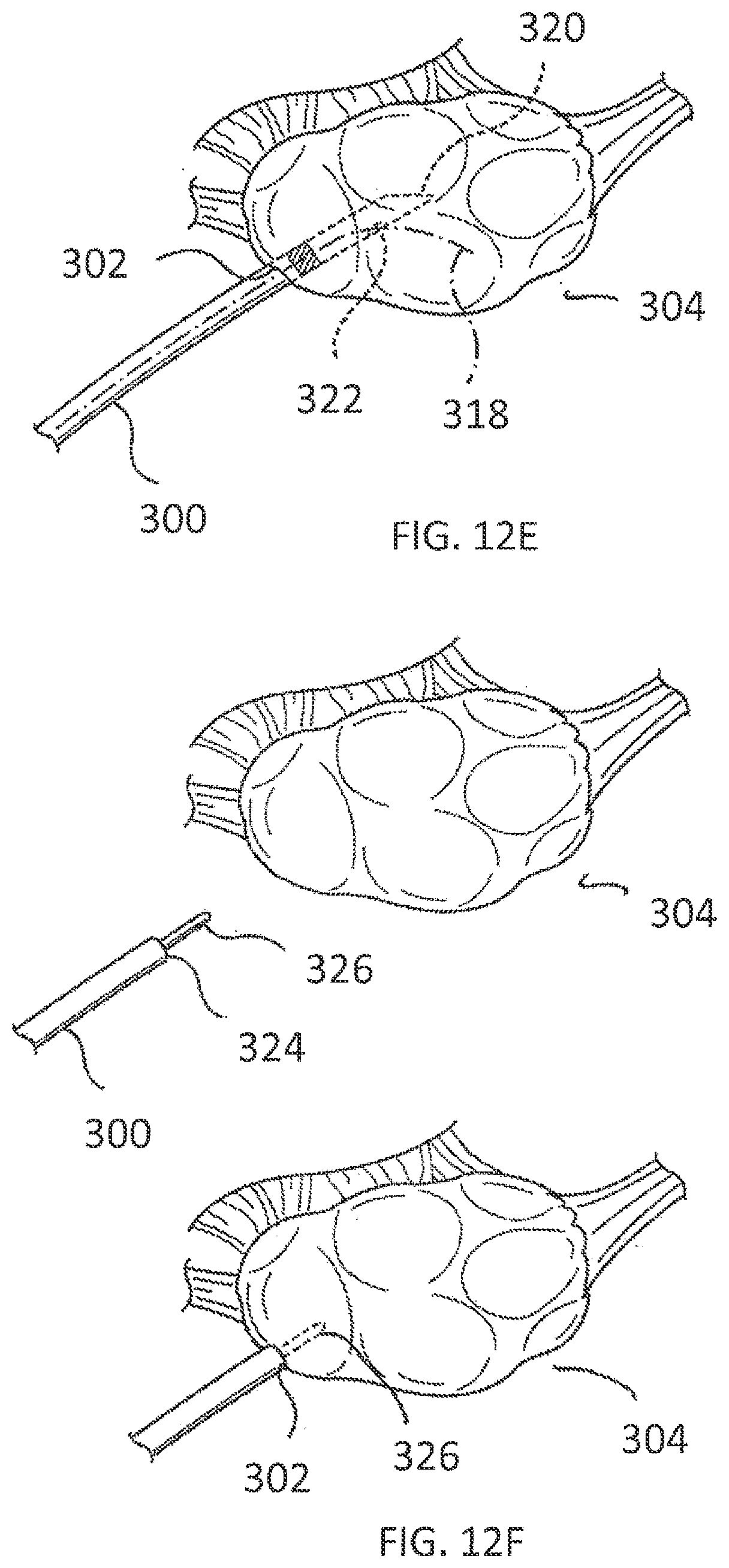 Patent US11793564 Figure 8 – Methods and systems for the treatment of polycystic ovary syndrome