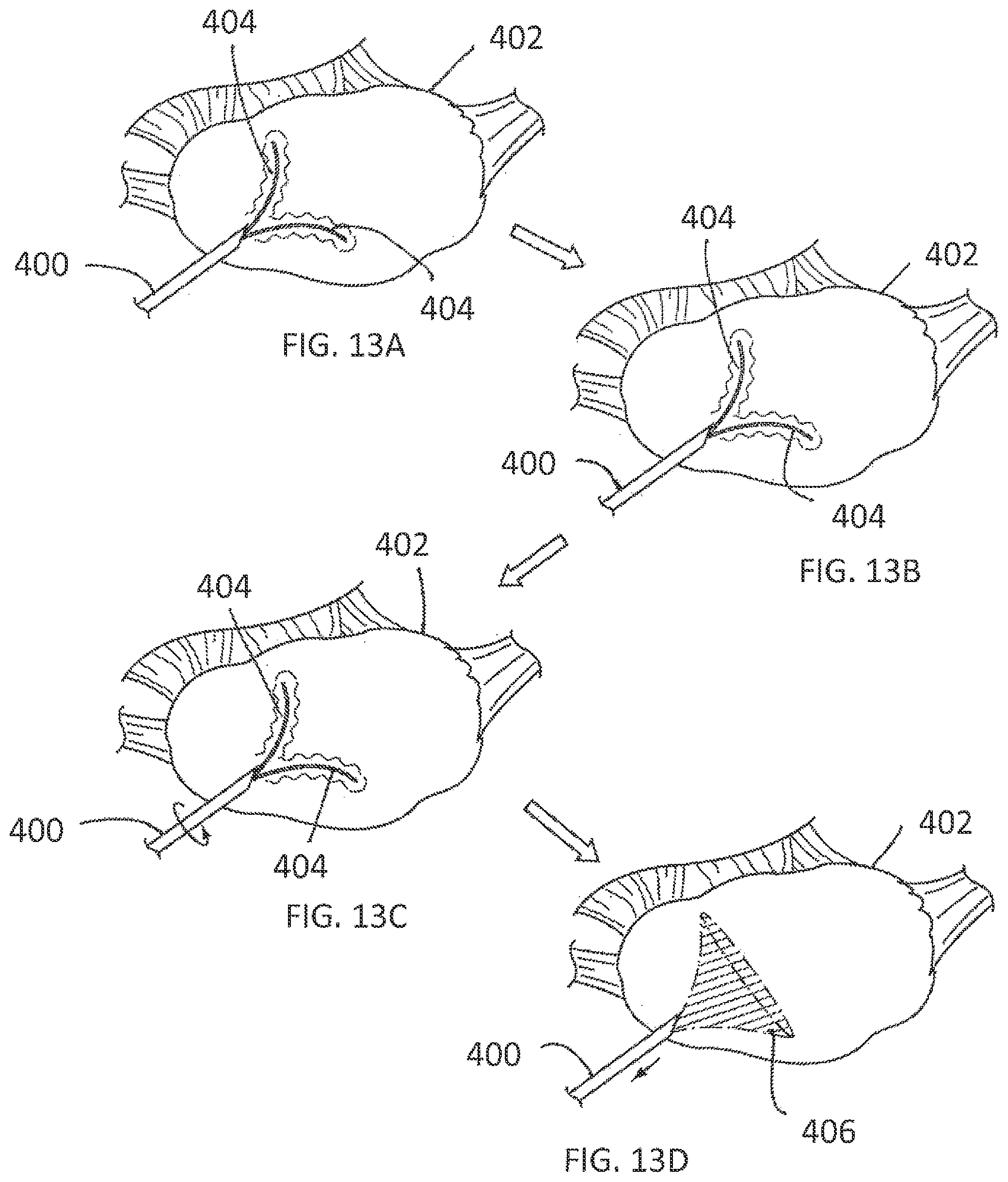 Patent US11793564 Figure 9 – Methods and systems for the treatment of polycystic ovary syndrome