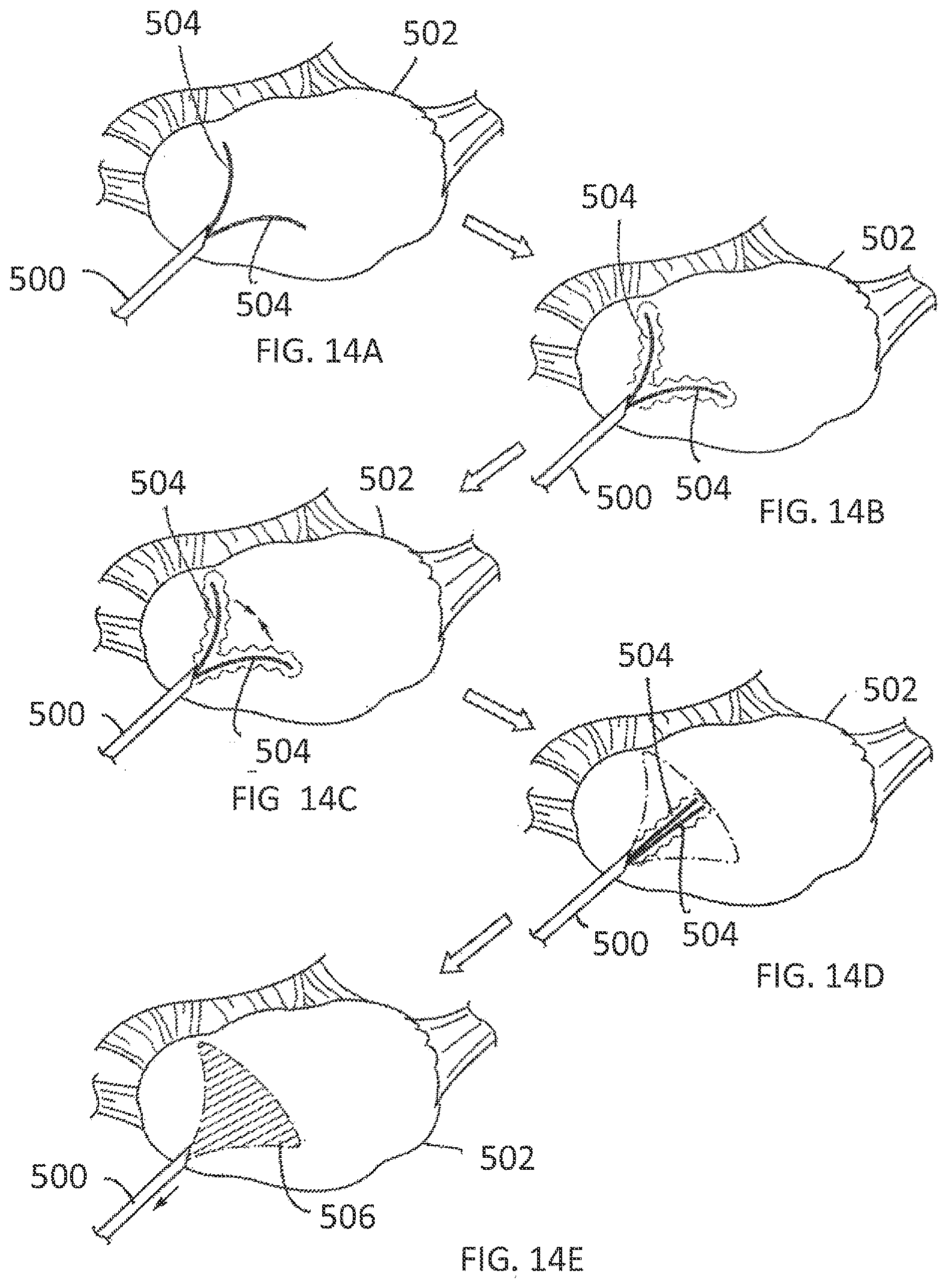 Patent US11793564 Figure 10 – Methods and systems for the treatment of polycystic ovary syndrome