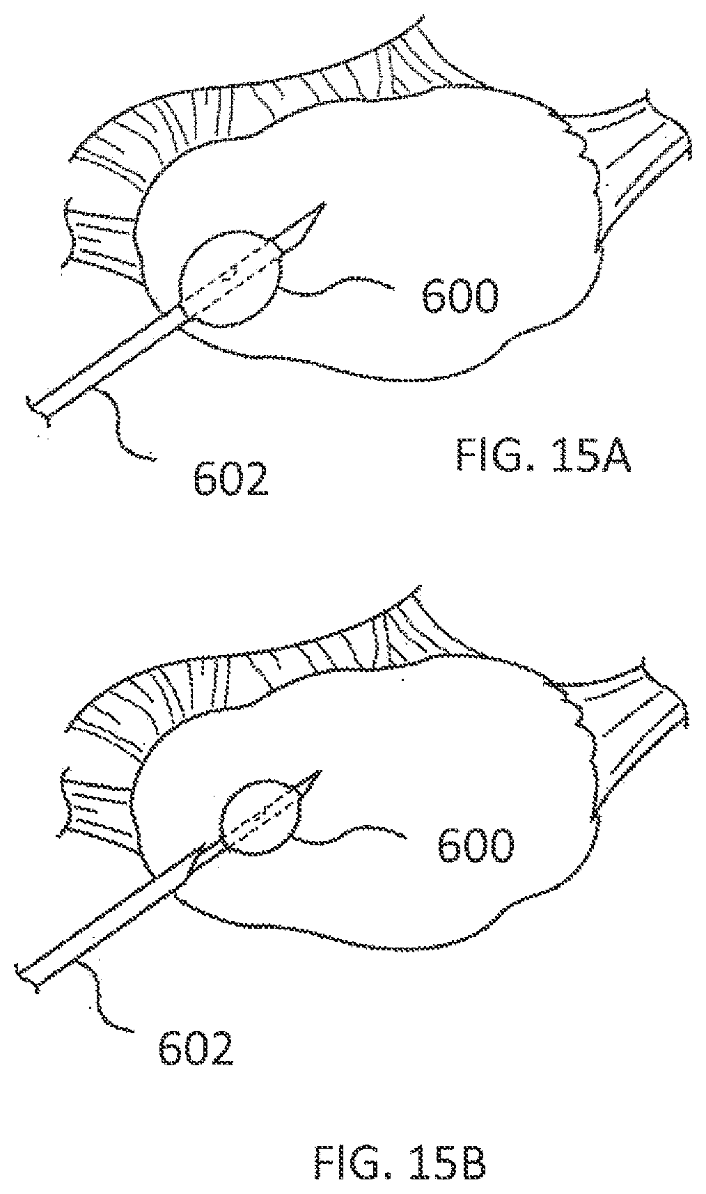 Patent US11793564 Figure 11 – Methods and systems for the treatment of polycystic ovary syndrome