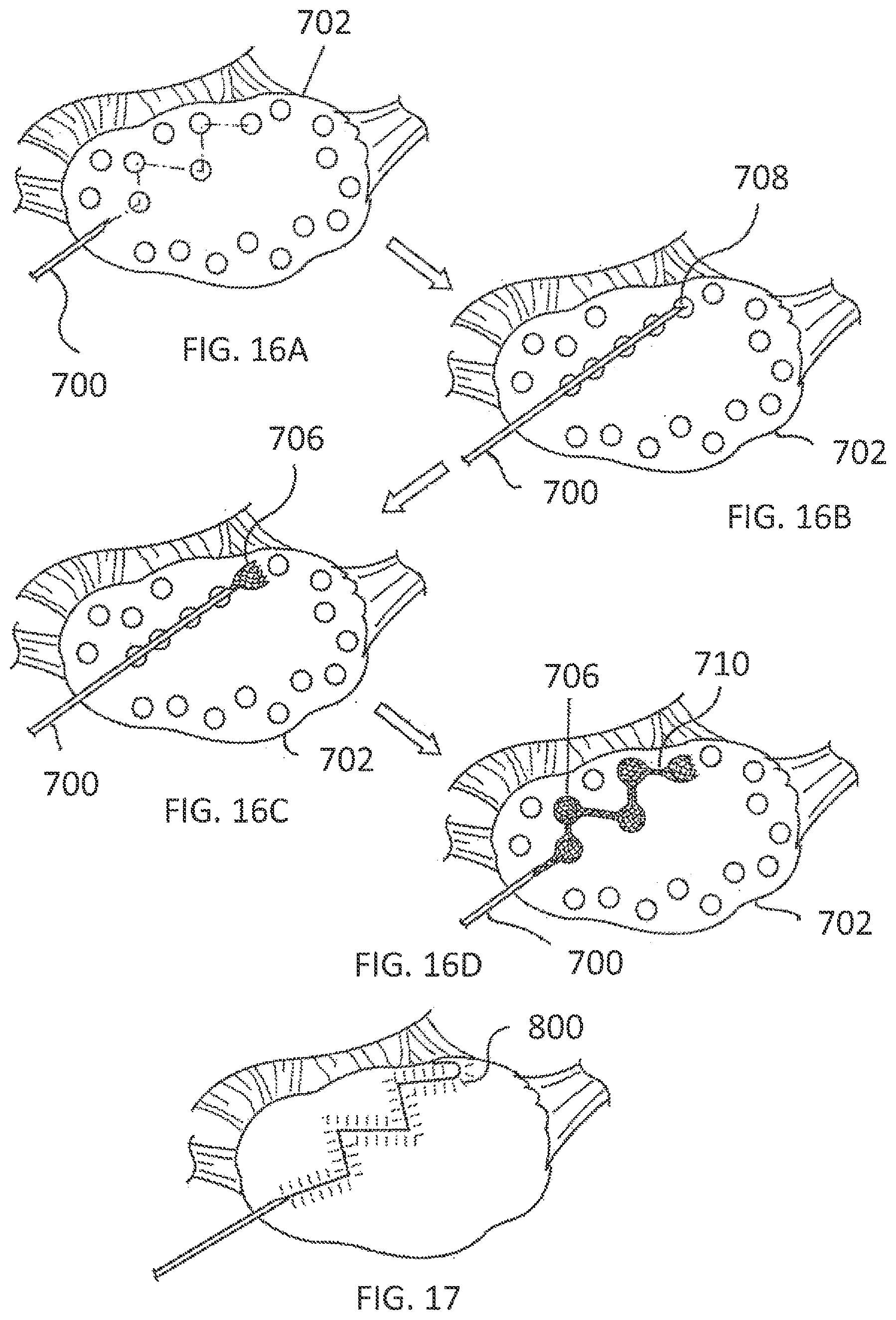 Patent US11793564 Figure 12 – Methods and systems for the treatment of polycystic ovary syndrome